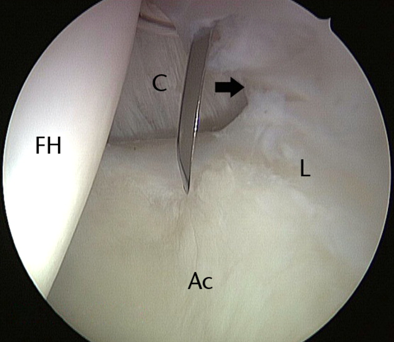 Figs. 9a - 9c 
          Arthroscopic images of the left
hip of a 36-year-old woman who had a previous hip arthroscopy three
years earlier, showing a) capsulolabral adhesions (arrow) in the
area of the perilabral sulcus corresponding to the previous surgical
intervention, in contrast to the normal capsule seen further anteriorly,
b) removal of the adhesions, and c) chondroplasty with labral repair
using a suture anchor. Symptoms improved as early as eight weeks post-operatively
(FH, femoral head; Ac, acetabulum; L, labrum; C, capsule).
        