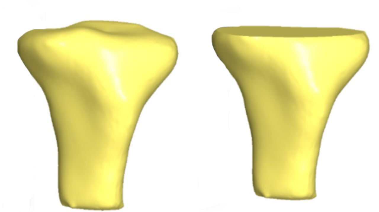Fig. 1 
            Three-dimensional CT reconstructions
before (left) and after resection (right).
          