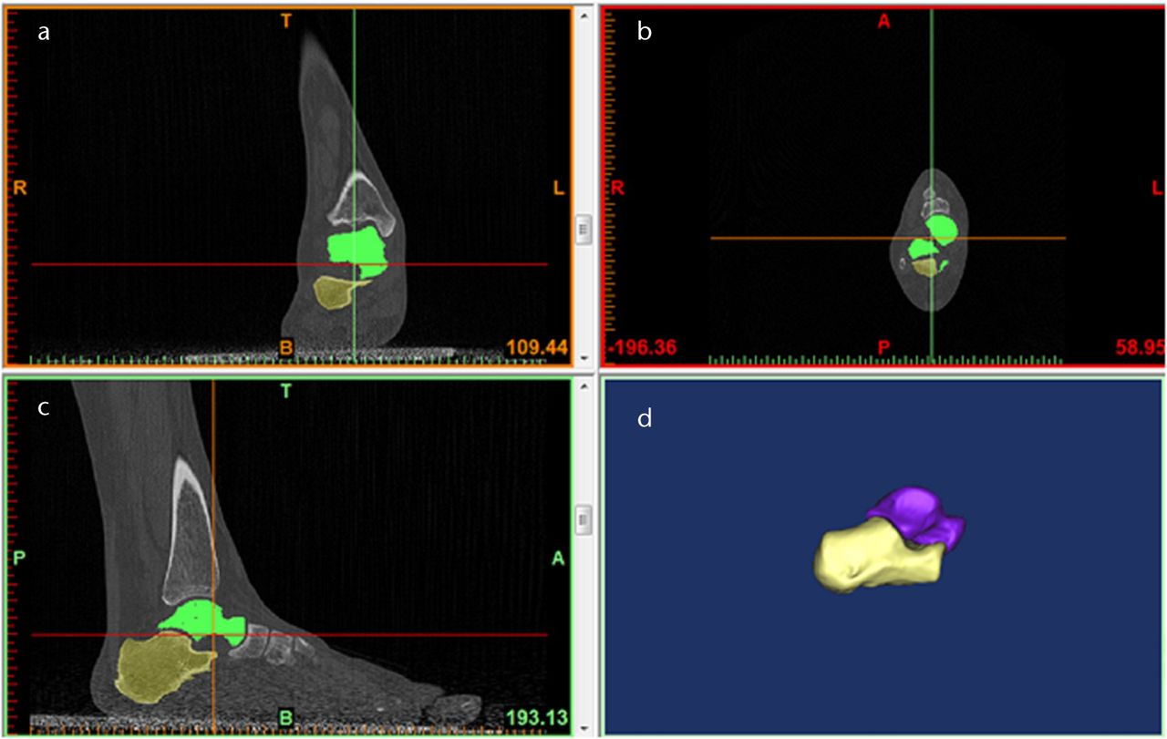 Fig. 4 
            
              Figures 4a to 4c – axial CT images of
the ankle. Figure 4d – three-dimensional reconstruction of the CT
images of the talus and calcaneus.
          