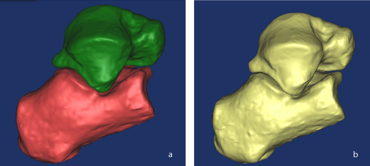 Fig. 5 
            Three-dimensional CT images of the talocalcaneal
joint a) before merge and b) after merge.
          
