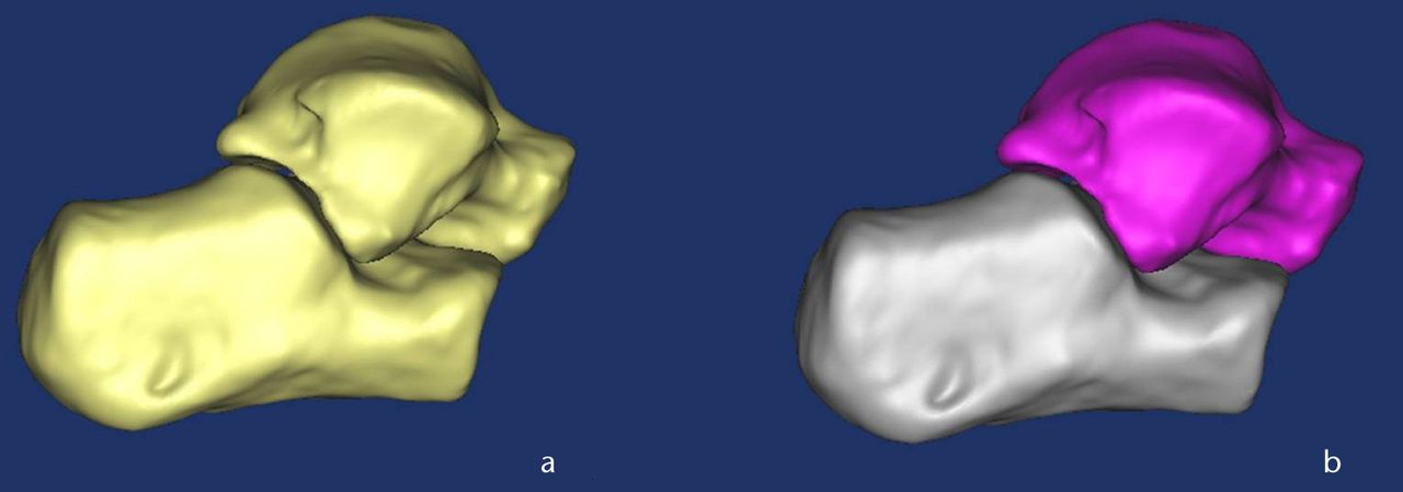 Fig. 8 
            Three-dimensional CT images of the talocalcaneal joint
a) before split and b) after split.
          