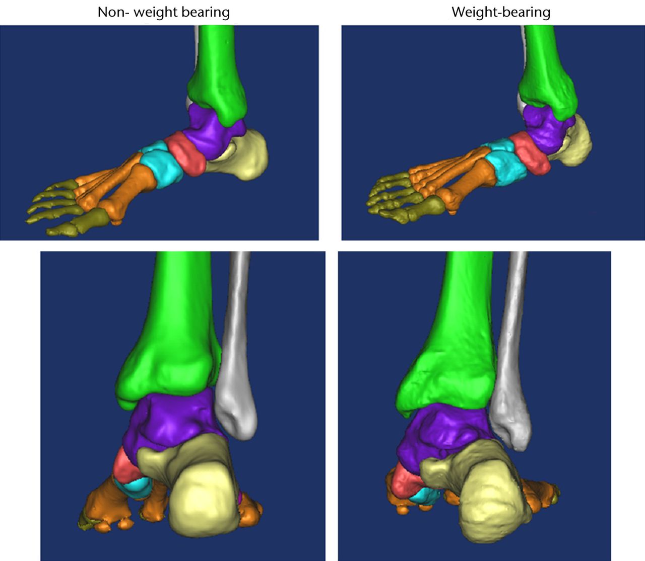Fig. 9 
          Lateral (top) and posterior (bottom)
three-dimensional CT images of a stage II posterior tibial tendon
dysfunction (PTTD) flatfoot subject’s right foot under non-weight-bearing
(left) and full-body-weight-bearing (right).
        