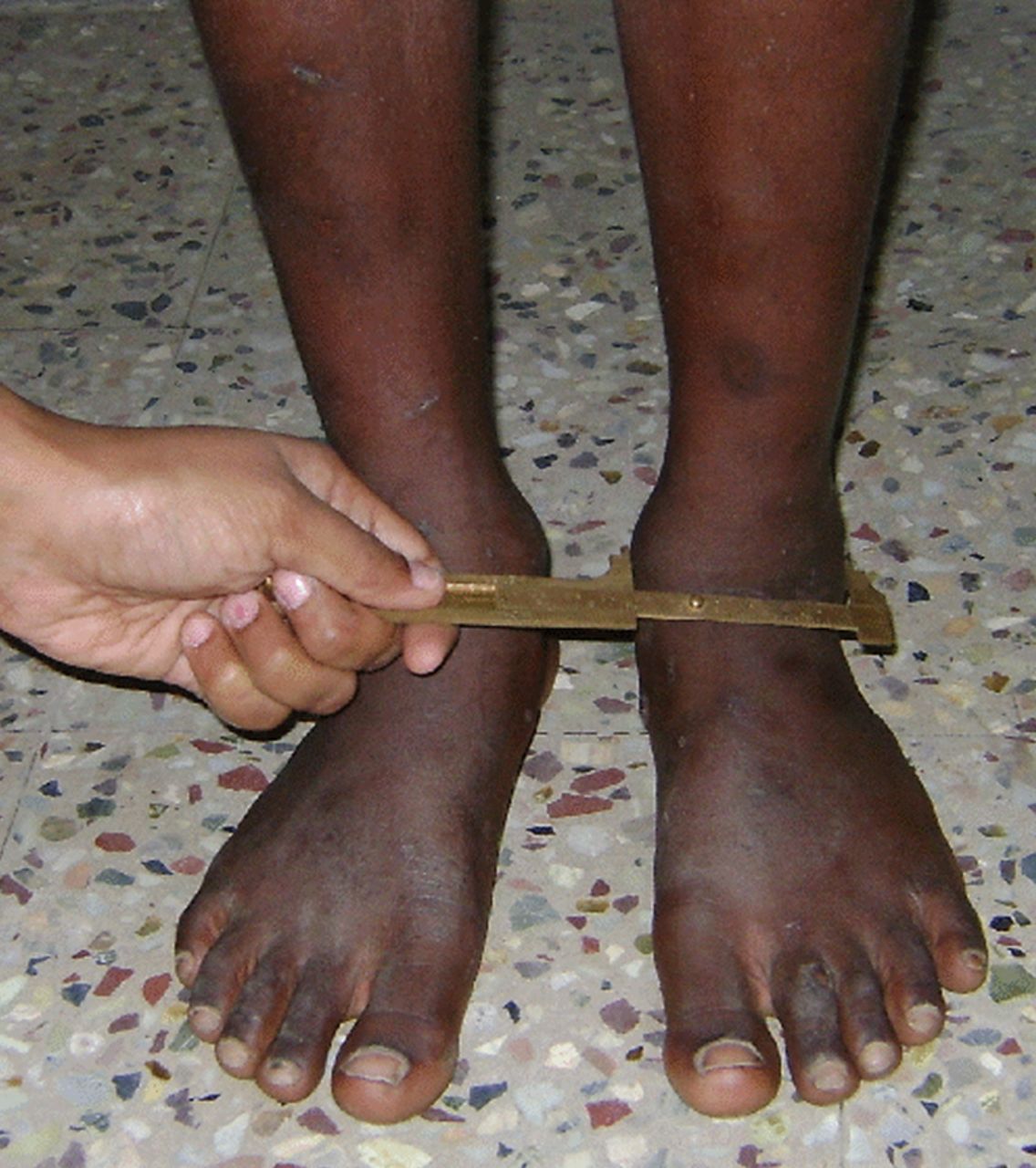 Fig. 2 
          Clinical photograph showing the determination
of centre of the ankle using a vernier calliper.
        