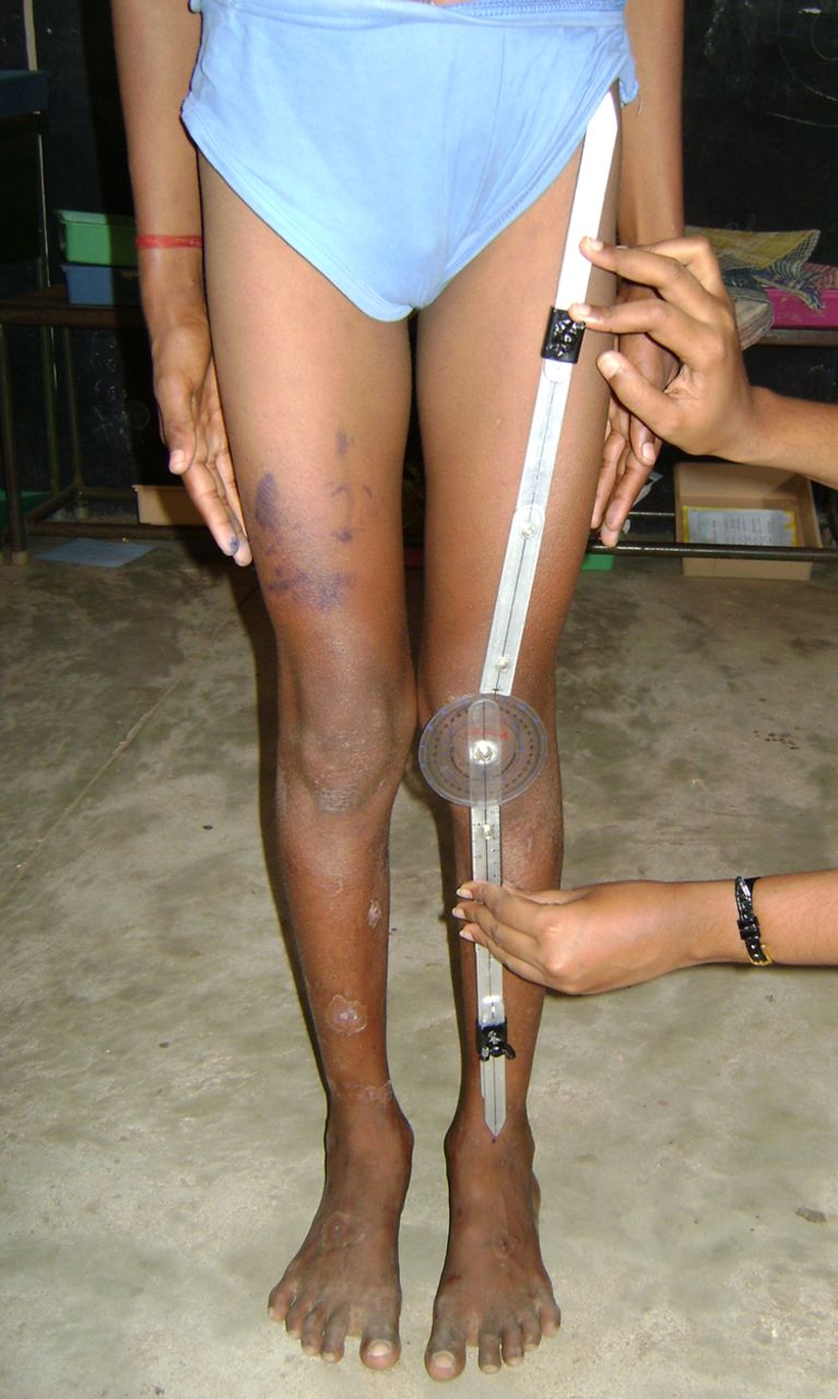 Fig. 4 
          Clinical photograph showing the determination
of the tibiofemoral angle using customised standardised goniometer.
        