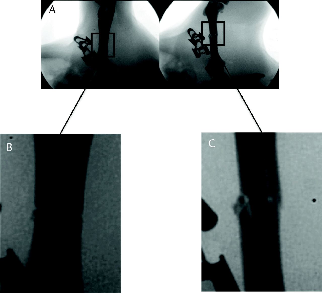 Fig. 4 
          Fluoroscopic images showing an example
of slight comminution in an acceptable fracture with fracture sites
magnified.
        