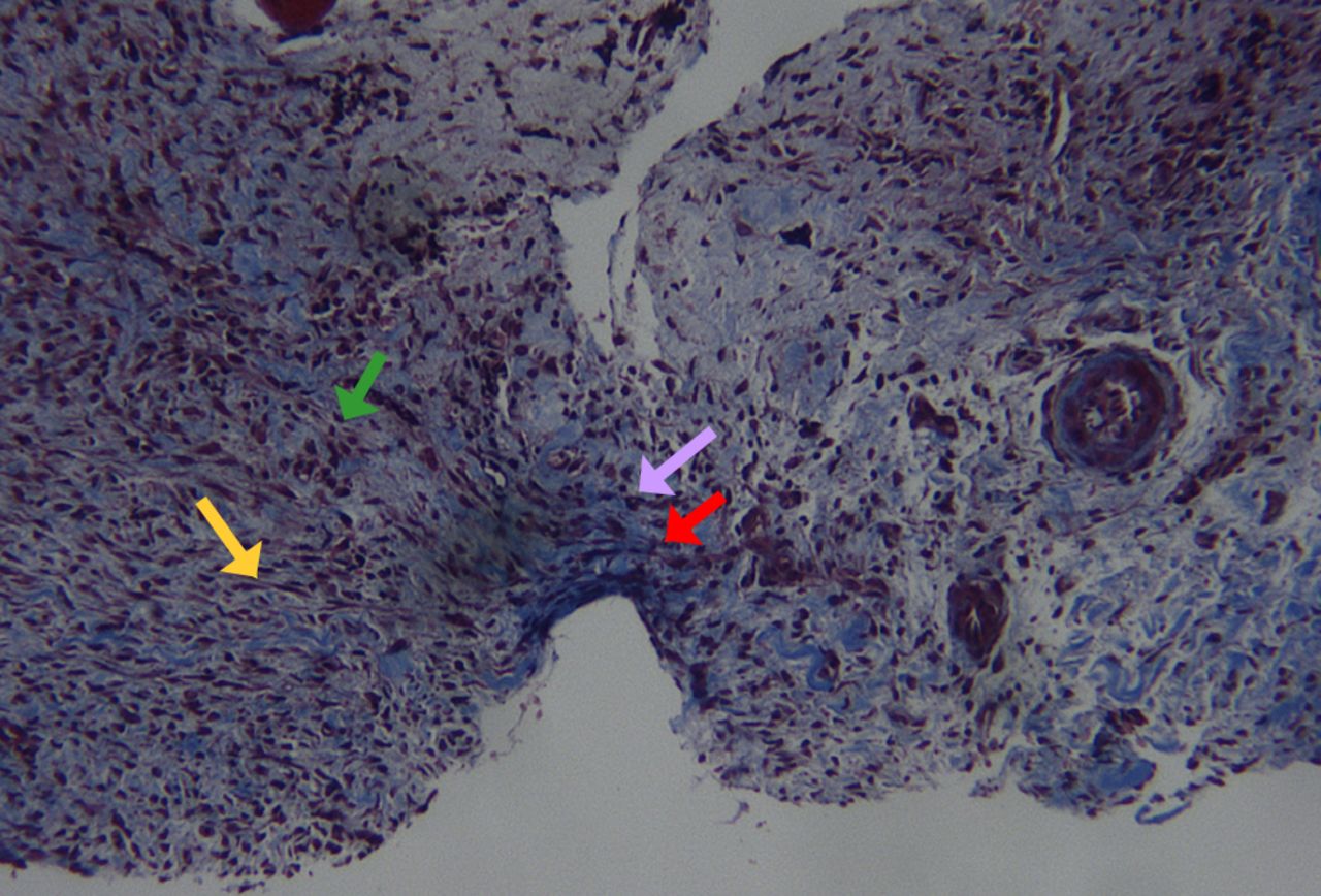 Fig. 5 
          Histological image of soft callus harvesting
at day seven (Masson’s trichrome staining). Note the presence of
mesenchymal stem cells (green arrow), fibroblasts (yellow arrow),
collagen fibers (red arrow) along with hypertrophic and proliferating
chondrocytes (pink arrow). Note also the absence of any surrounding
soft tissues (original magnification ×25).
        