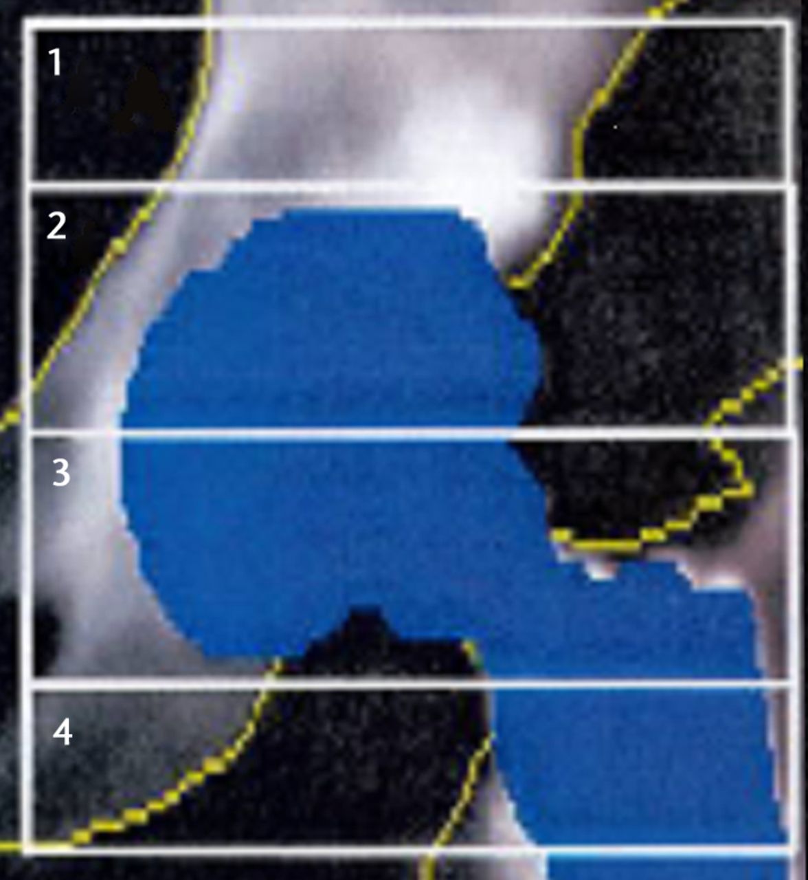 Figs. 2a - 2b 
          Images showing the regions of interest
for the assessment of bone mineral density in a) the affected hip
and b) the contralateral hip.
        