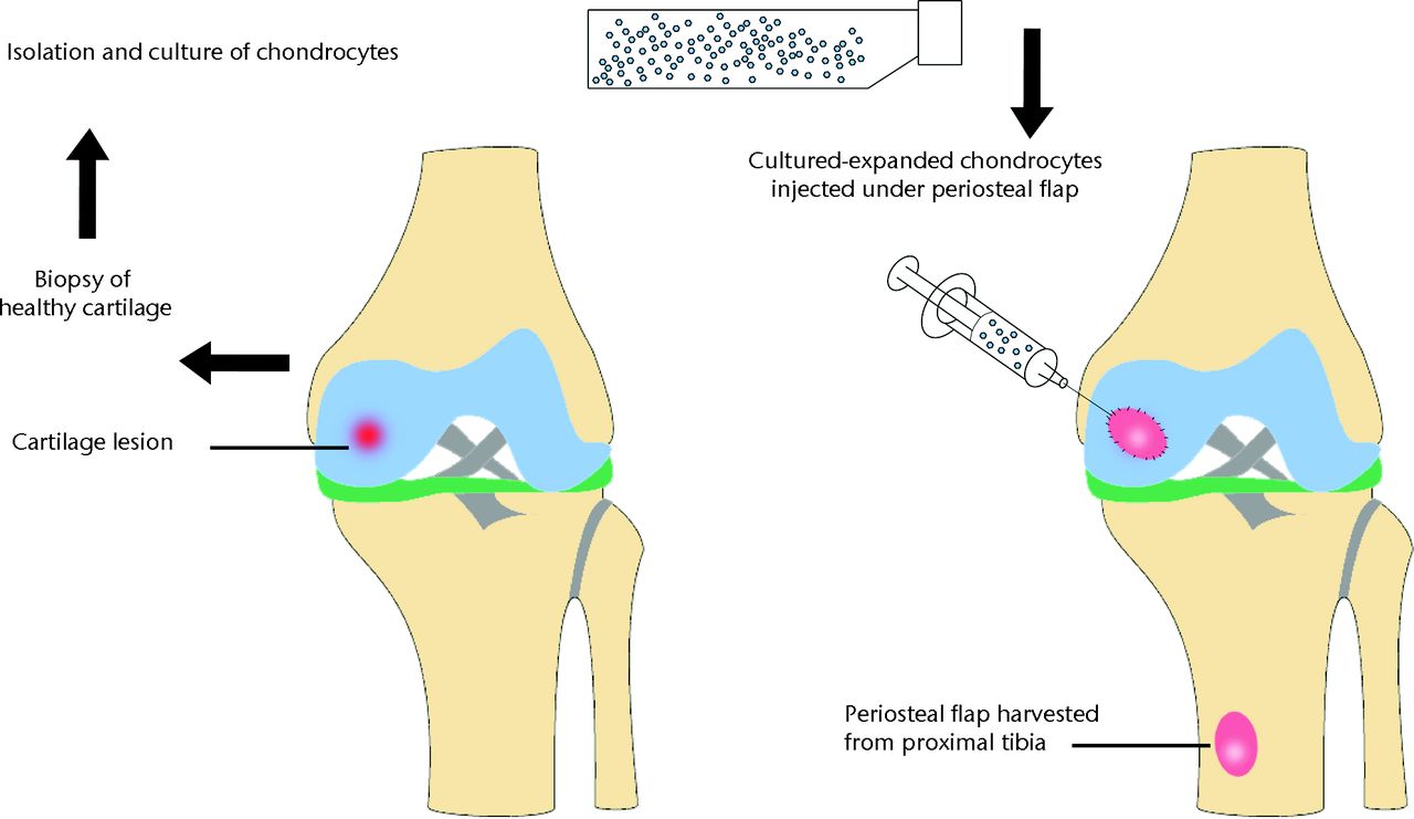 Fig. 2 
        Diagram of the autologous chondrocyte
implantation (ACI) procedure. A sample of healthy cartilage is isolated
and then expanded in vitro over two to three weeks.
The chondrocytes are then implanted into the defect and covered
with a periosteal patch.
      