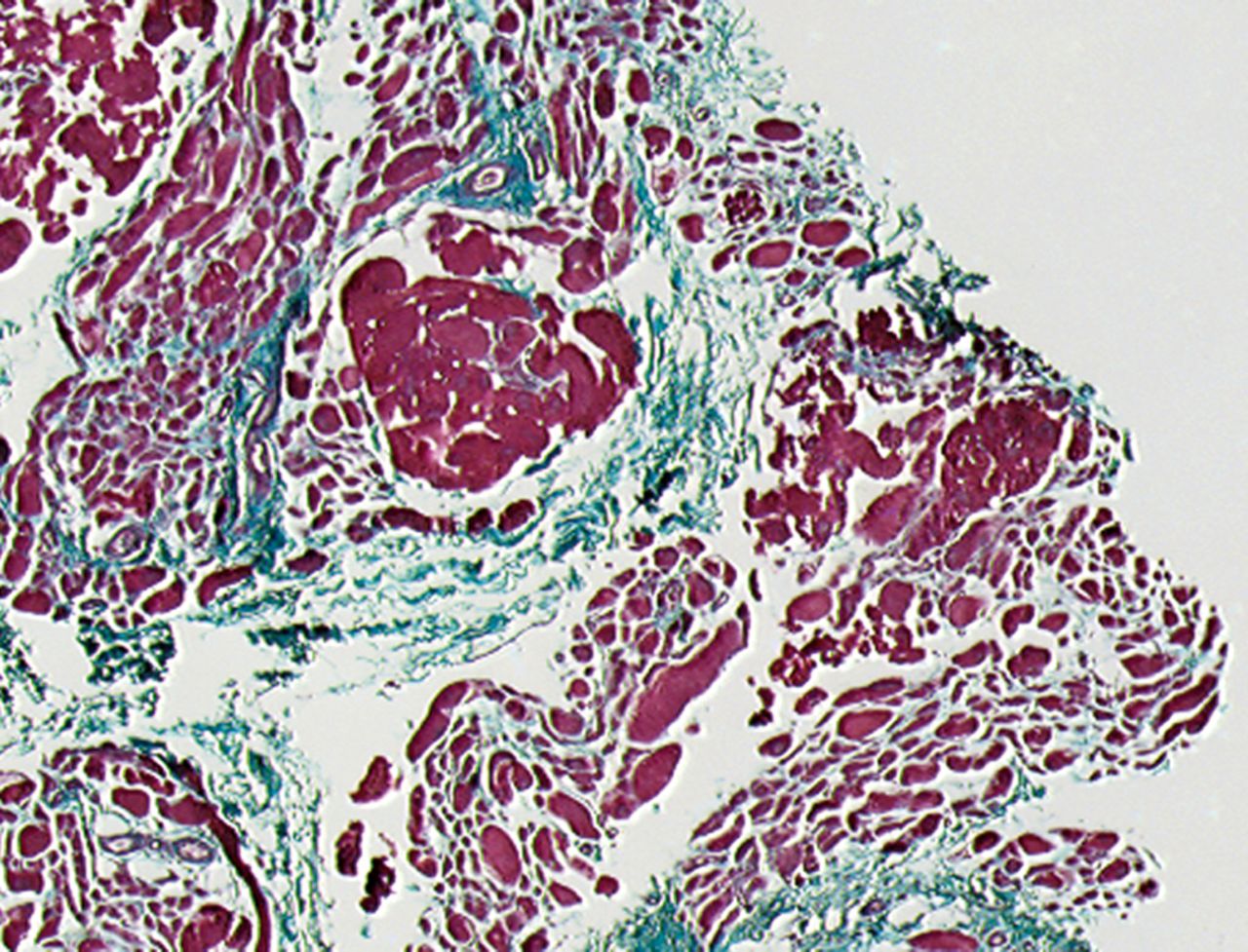 Figs. 2a - 2b 
          Histological images showing Masson’s
trichrome staining of a representative muscle biopsy a) pre- and
b) three months post-transplantation (magnification 5×).
        