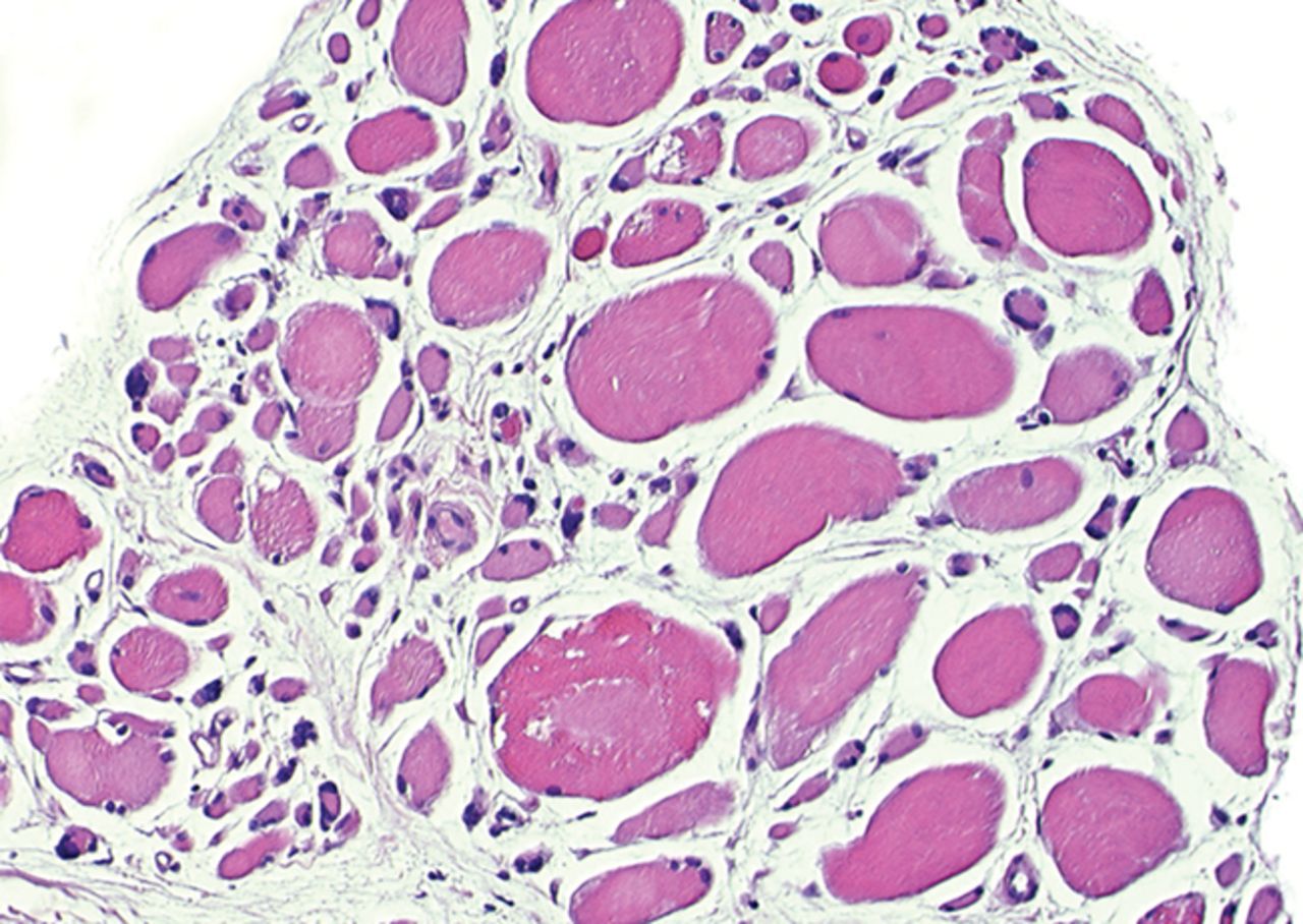 Figs. 4a - 4h 
          Histological images
for specimens taken pre-transplantation (left column) and at three
months follow-up (right column), showing staining of a representative muscle
biopsy with haematoxylin and eosin (a and b; ×20), Pax7 (c and d,
×40), vWF (e and f, ×40) and CD56 (g and h, ×40).
        