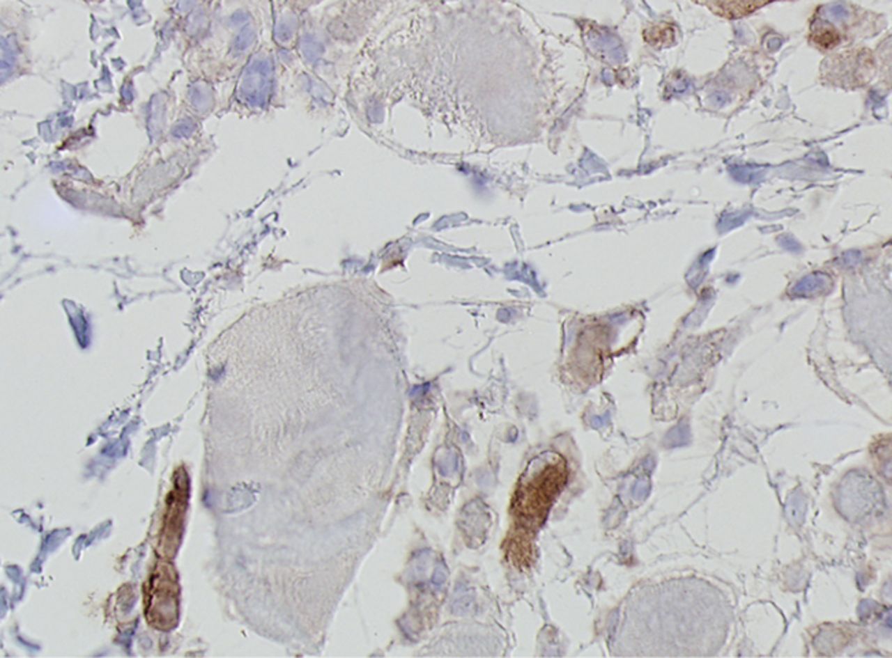 Figs. 4a - 4h 
          Histological images
for specimens taken pre-transplantation (left column) and at three
months follow-up (right column), showing staining of a representative muscle
biopsy with haematoxylin and eosin (a and b; ×20), Pax7 (c and d,
×40), vWF (e and f, ×40) and CD56 (g and h, ×40).
        