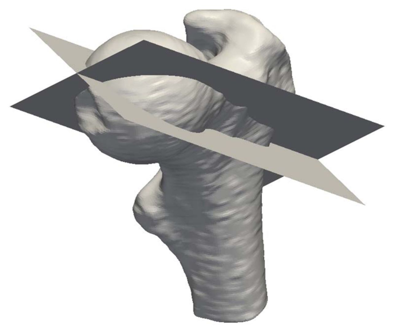 Figs. 1a - 1c 
           a) A 3D surface rendered
image of a proximal femur, with the 3:00 (anterior) and 1:30 (anterosuperior)
planes superimposed. MRI images representative of b) the 3:00 and
c) 1:30 imaging planes.
        