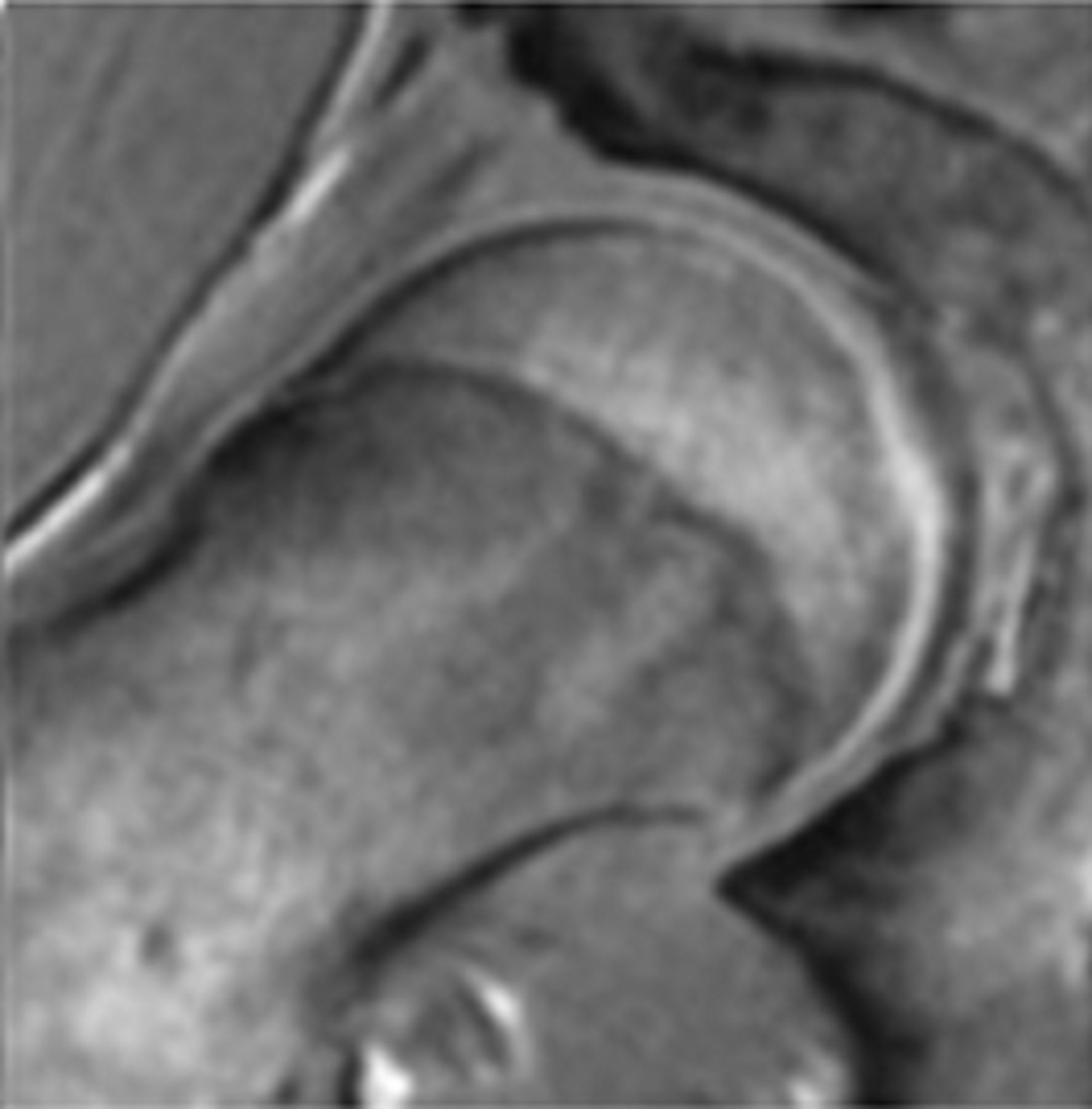 Figs. 2a - 2f 
          Representative MRI images
showing the six physeal grades in study subjects; a) grade 1, b)
grade 2, c) grade 3, d) grade 4, e) grade 5, and f) grade 6.
        