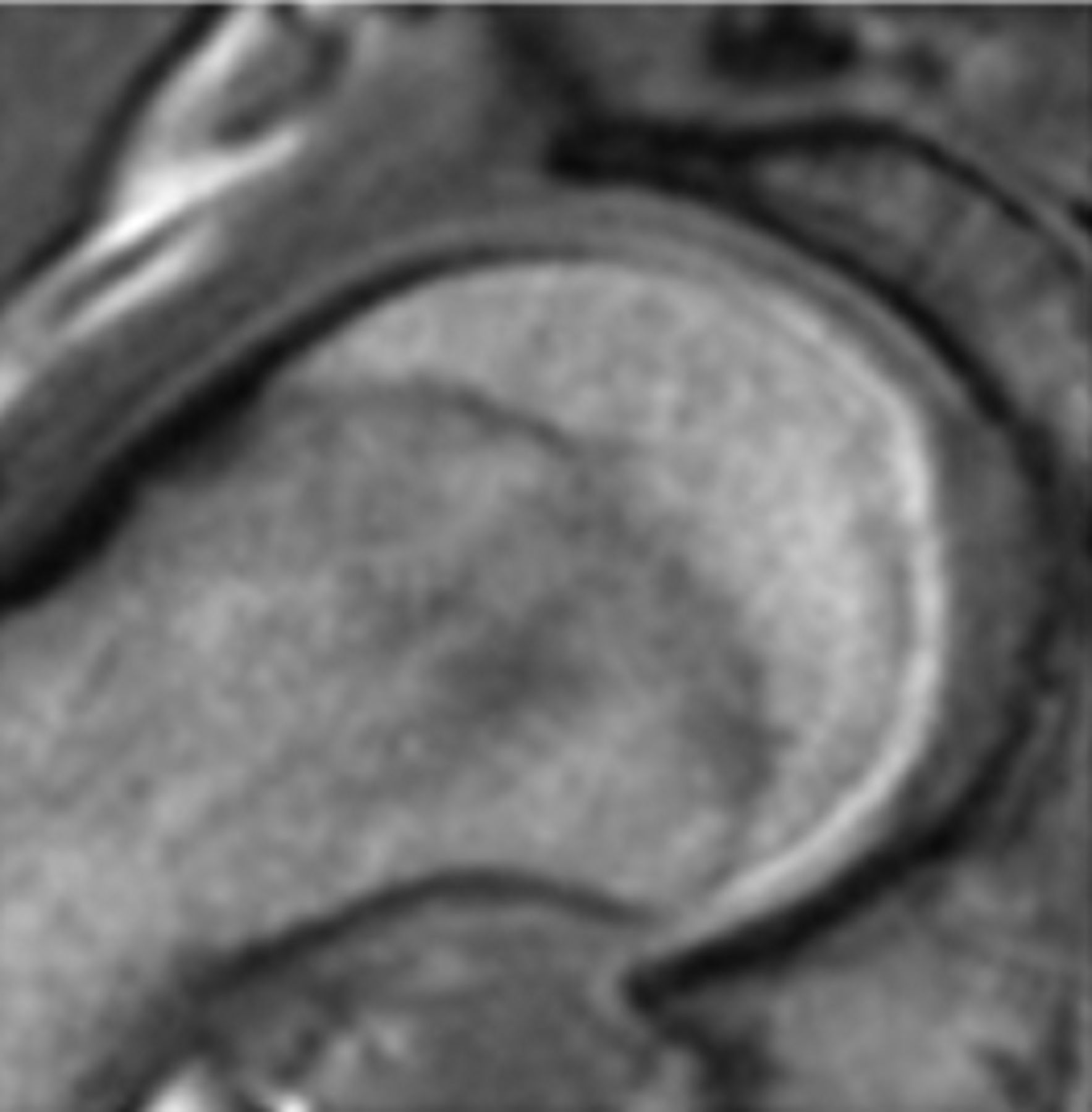 Figs. 2a - 2f 
          Representative MRI images
showing the six physeal grades in study subjects; a) grade 1, b)
grade 2, c) grade 3, d) grade 4, e) grade 5, and f) grade 6.
        