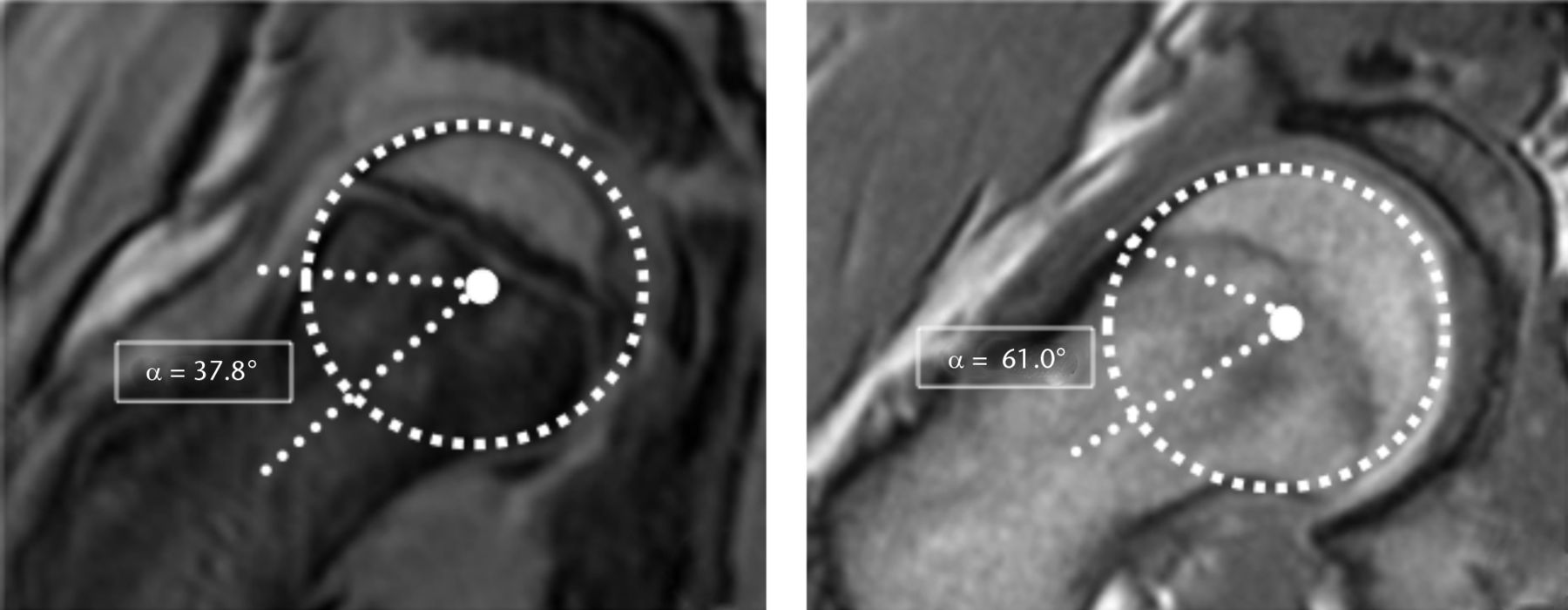 Fig. 4 
          MRI images at the 1:30 position of a)
a ten year old boy with grade 1 physis (completely unfused) with
normal alpha angle, 37.8° and b) a16 year old boy with grade 6 physis
(completely fused) and elevated alpha angle, 61.0°, constituting
a cam deformity.
        