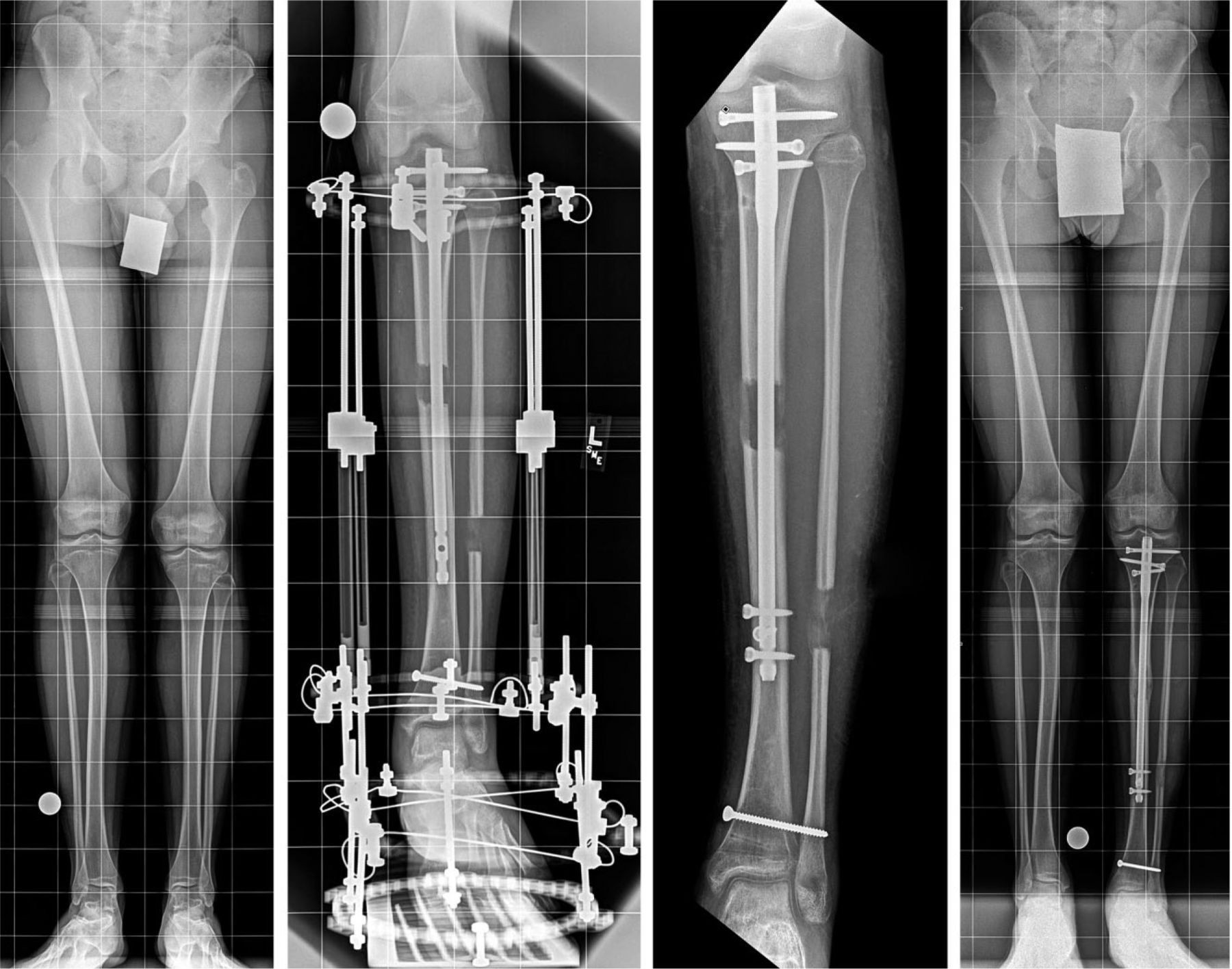 Fig. 3 
            Radiographs of (left) a young man with a history of clubfoot and a 3 cm left tibial discrepancy (second left) obtained after lengthening by 3 cm. The external fixation spans the ankle to prevent equinus, and the distal tibial fibular syndesmosis is transfixed with a bone screw. The nail rises up during lengthening, but it still has sufficient length in the distal segment for stability; (second right) showing nail is locked distally, and external fixation is removed. The distal tibial fibular screw prevents proximal migration of the distal fibula; and (right) obtained four months after nail is locked showing that complete healing has been achieved (copyright 2015, Rubin Institute for Advanced Orthopedics, Sinai Hospital of Baltimore).
          