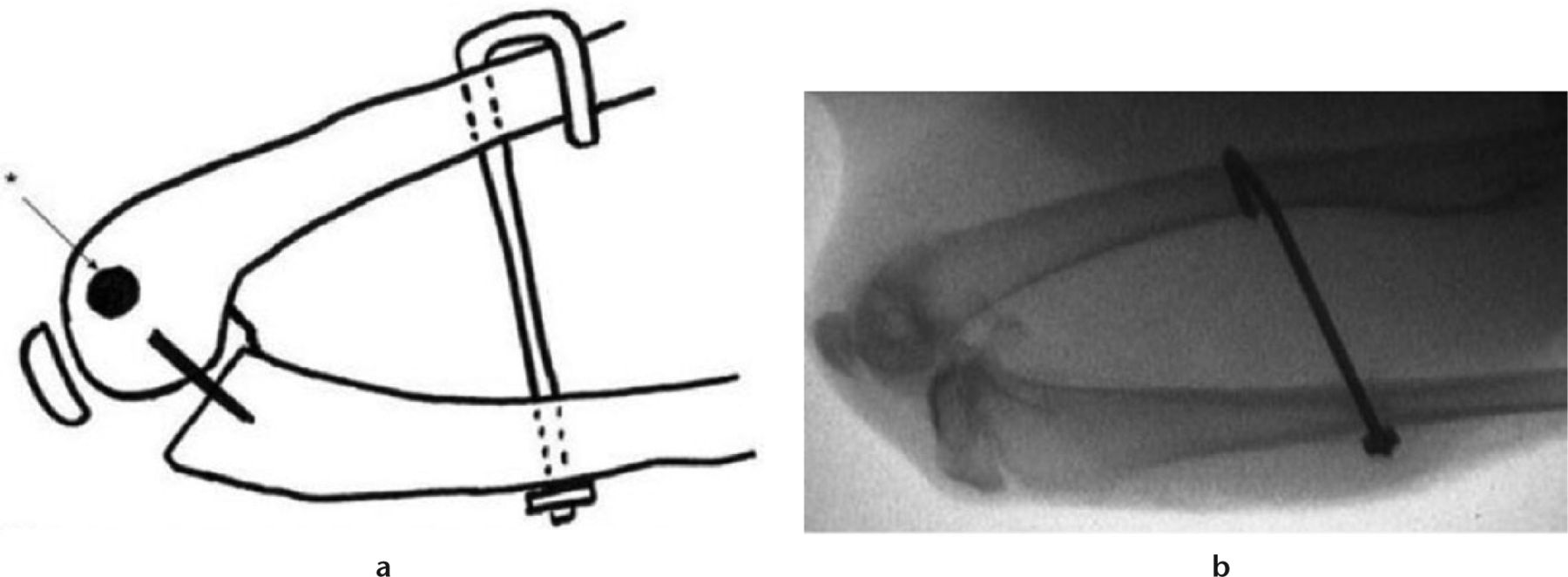 Fig. 1 
          Intra-operative fluoroscopy of operative limb before Kirschner wire removal.
        