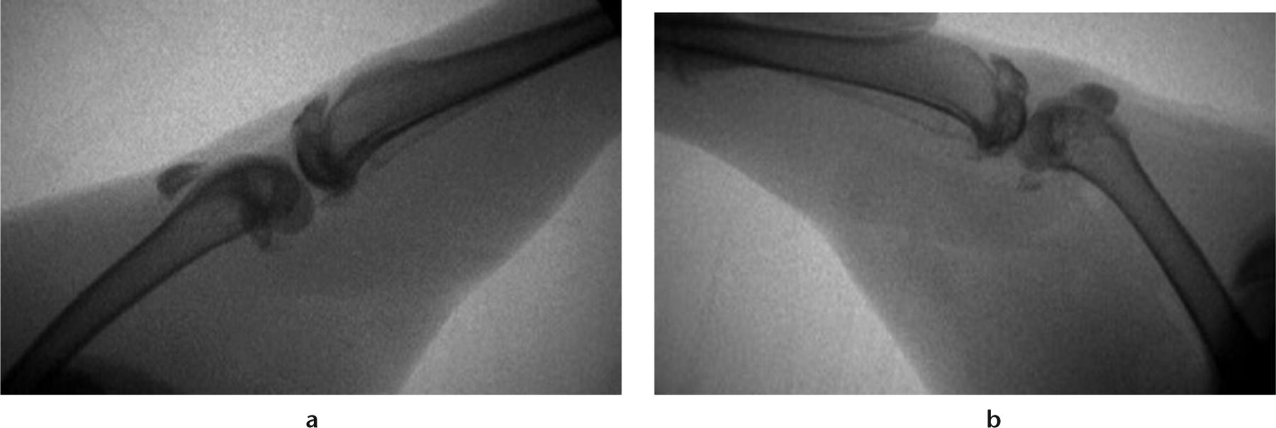 Fig. 2 
          Radiographs of a) the contralateral limb in gentle extension and b) the operative limb following limited capsular release, with a gentle extension force. (From Barlow JD, Hartzler RU, Abdel MP, et al. Surgical capsular release reduces flexion contracture in a rabbit model of arthrofibrosis. J Orthop Res 2013;31:1529-1532).14
        