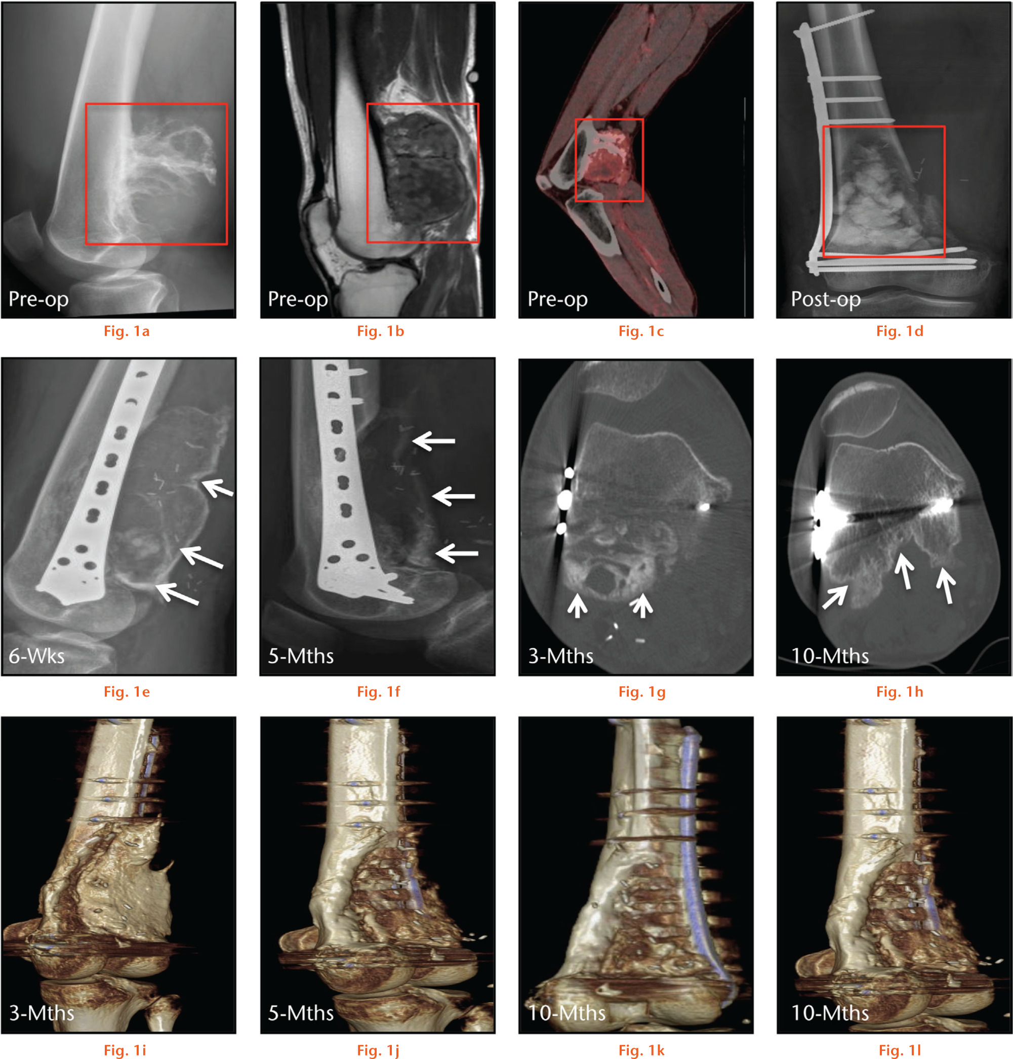  
            Time course observations of bone defect from a wide periosteal chondrosarcoma resection, treated with hydroxyapatite-calcium sulphate (HA-CS) and HA-CS-gentamicin (G) biomaterial. Panels (a), (b) and (c) represent pre-operative radiograph, MRI and PET-CT images of the tumour (red box), while panel (d) shows the bone defect filled with the biomaterial (red box) post-operatively. Arrows in the radiographs in panel (e) indicate bone formation in areas of direct muscle contact with HA-CS and HA-CS-G six weeks post-operatively, while arrows in panel (f) indicate reduced opacity of the regenerate at five months. Arrows in CT images in panels (g) and (h), respectively, indicate bone formation in the treated area posterior to the distal supracondylar region at three months post-operatively, progressively remodeling at ten months. Panels (i) through to (l) represent 3D reconstructions of CT images at three (i), five (j) and ten months (k), (l) showing progressive bone remodeling around the defect.
          