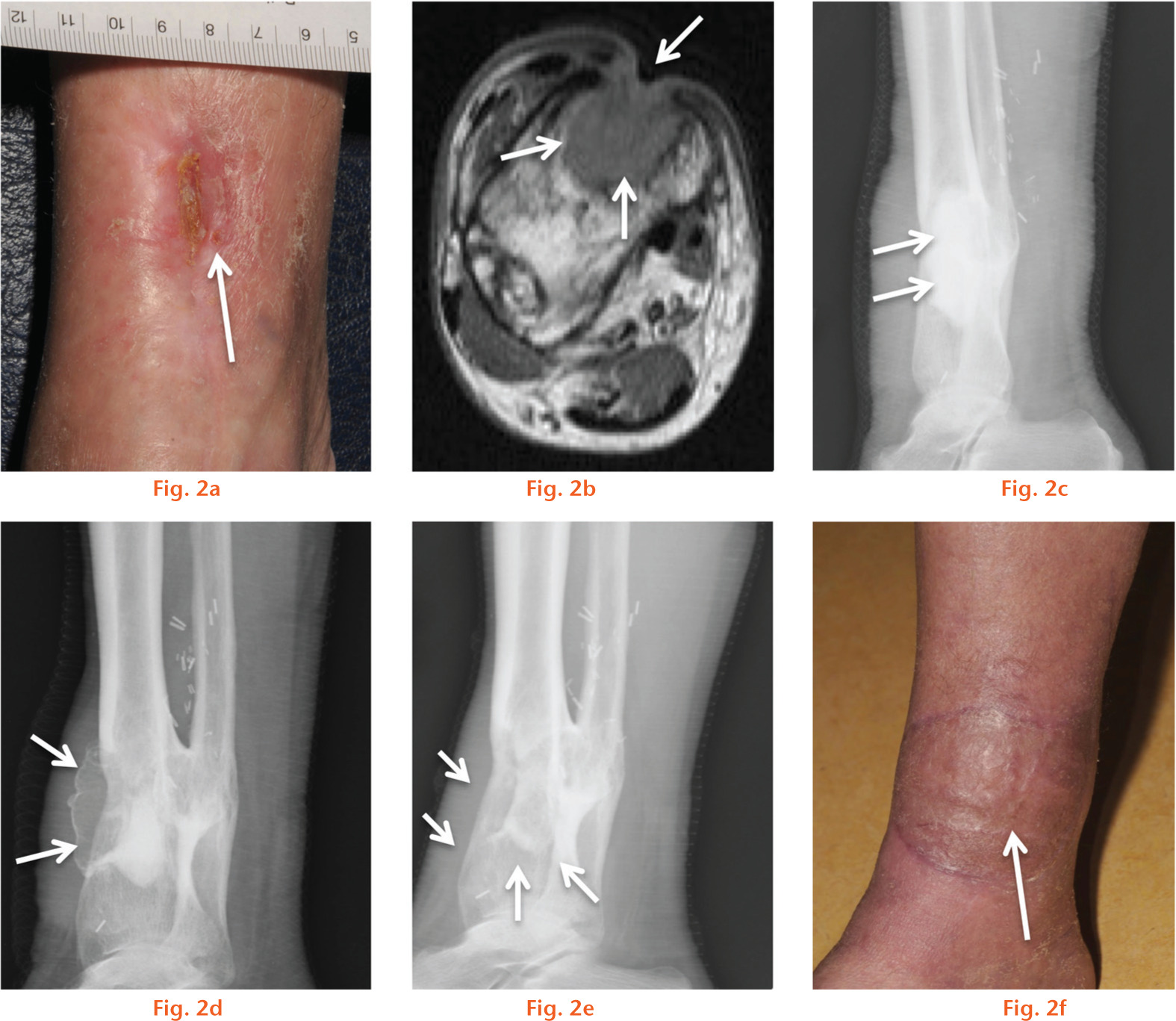  
            Time course observations from resected osteomyelitis treated with hydroxyapatite-calcium sulphate-gentamicin (HA-CS-G) biomaterial. Panel (a) is a digital image of the chronic osteomyelitis area of the tibia with visible wound as indicated by the arrow. Panel (b) represents a pre-operative MRI image used for diagnosis of osteomyelitis with white arrows emphasising the infected area. Radiograph in panel (c) represents the infected area filled with 10 ml of HA-CS-G post-operatively as indicated by white arrows while arrows in panel (d) indicate mineralisation in the overlaying muscle flap, four weeks post-operatively. Panel (e) represents a radiograph taken seven months post-operatively with arrows representing the resorbed bone previously observed at four weeks, while panel (f) represents a digital image of the healed wound seven months post-operatively.
          