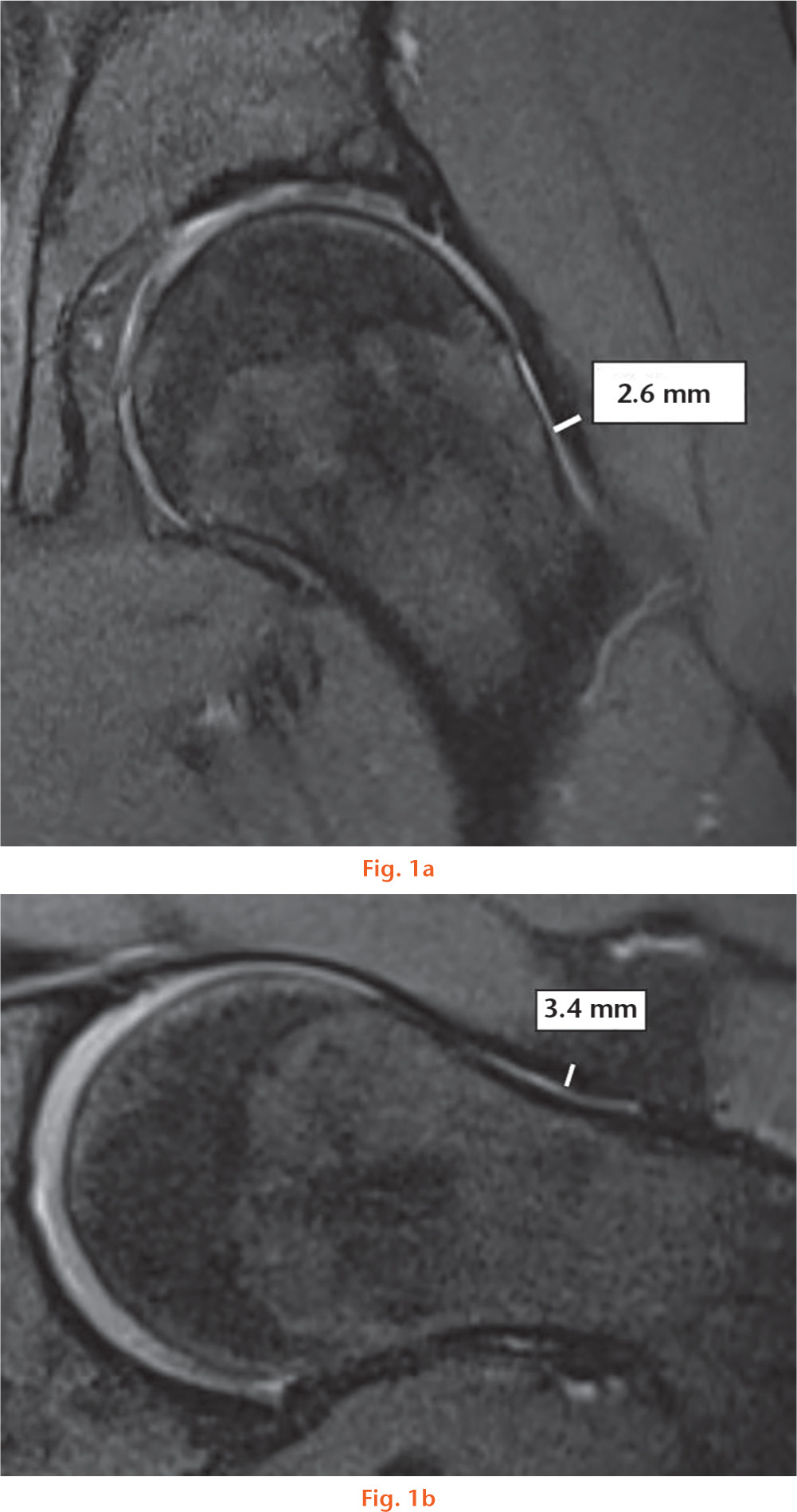  
          Measurement of the (a) superior (12:00) capsule thickness on an oblique coronal MRI image of an asymptomatic control subject and (b) anterior (3:00) capsule thickness on an oblique axial MRI image of an asymptomatic control subject.
        