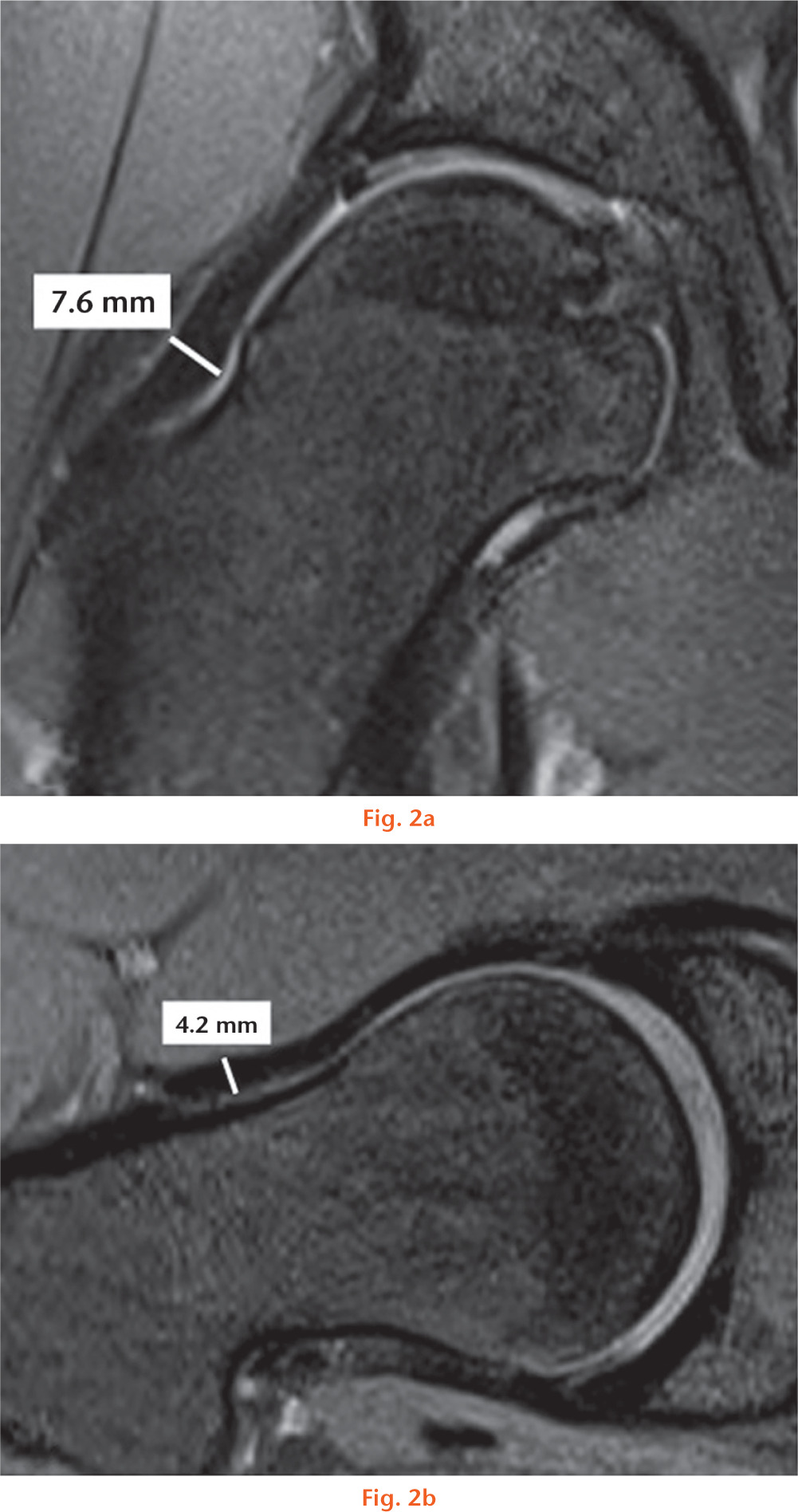  
          Measurement of the (a) superior (12:00) capsule thickness on an oblique coronal MRI image of a cam-FAI subject and (b) anterior (3:00) capsule thickness on an oblique axial MRI image of a cam-FAI subject.
        