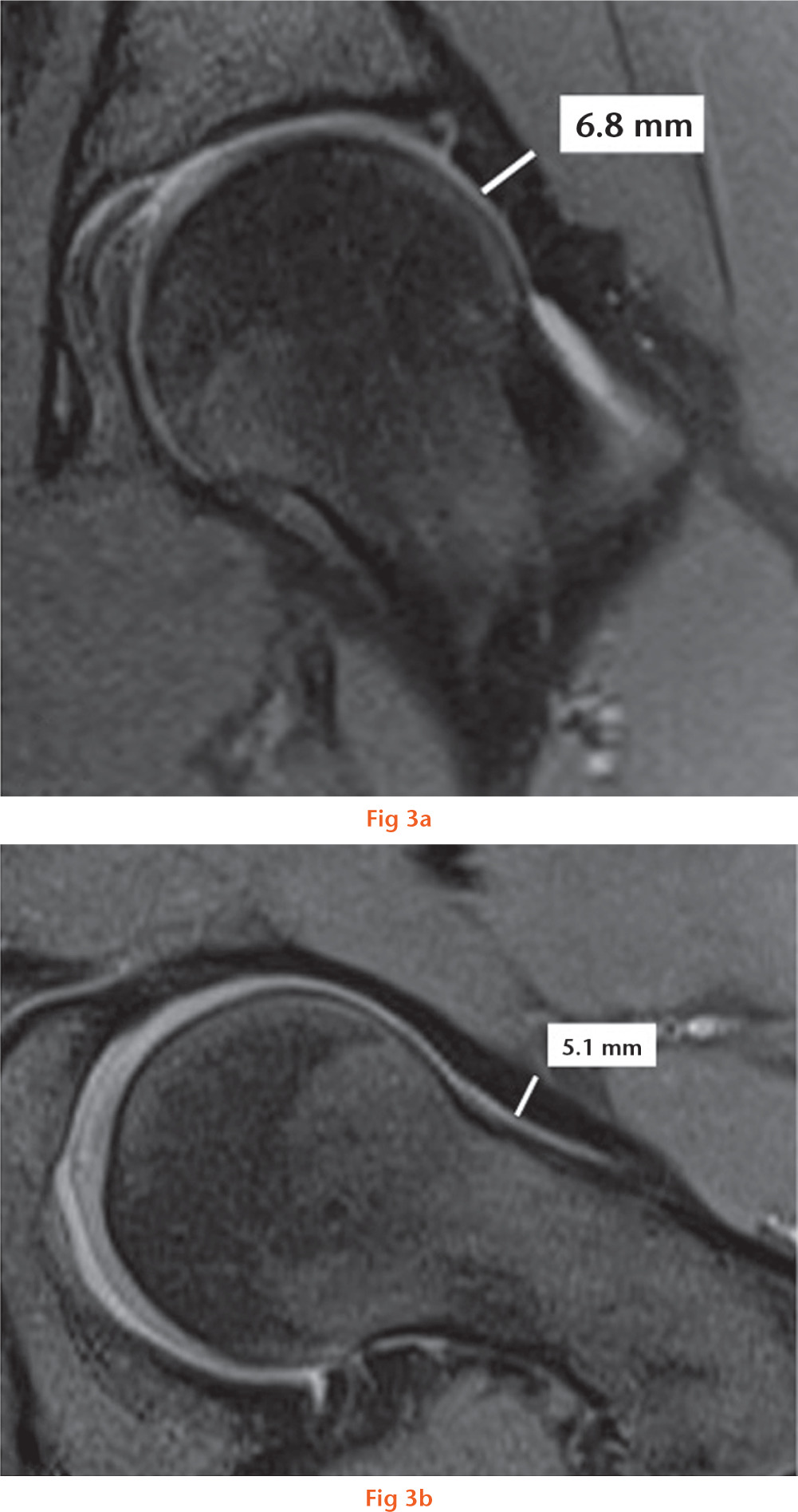  
          Measurement of the (a) superior (12:00) capsule thickness on an oblique coronal MRI image of a non-FAI subject (b) anterior (3:00) capsule thickness on an oblique axial MRI image of a non-FAI subject.
        