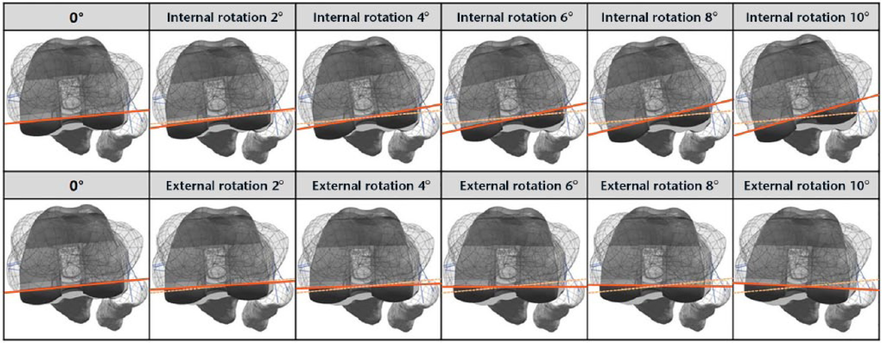 Fig. 1 
          Schematic of finite element model in neutral position and internal-external femoral malrotation conditions.
        