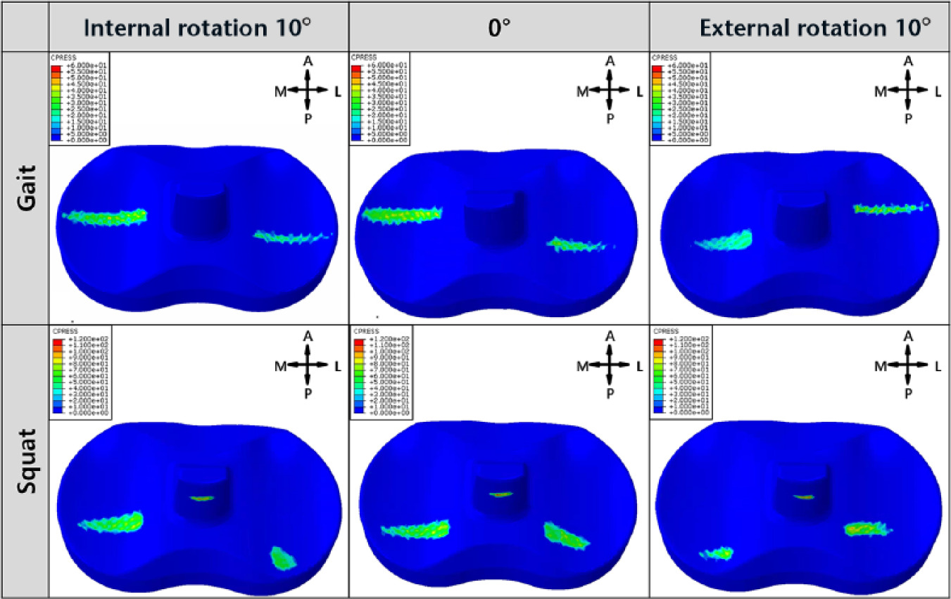 Fig. 4 
            Results of maximum contact stress distribution on the polyethylene insert in femoral component malrotation with normal, internal and external malrotation of 10° under gait and squat loading conditions.
          