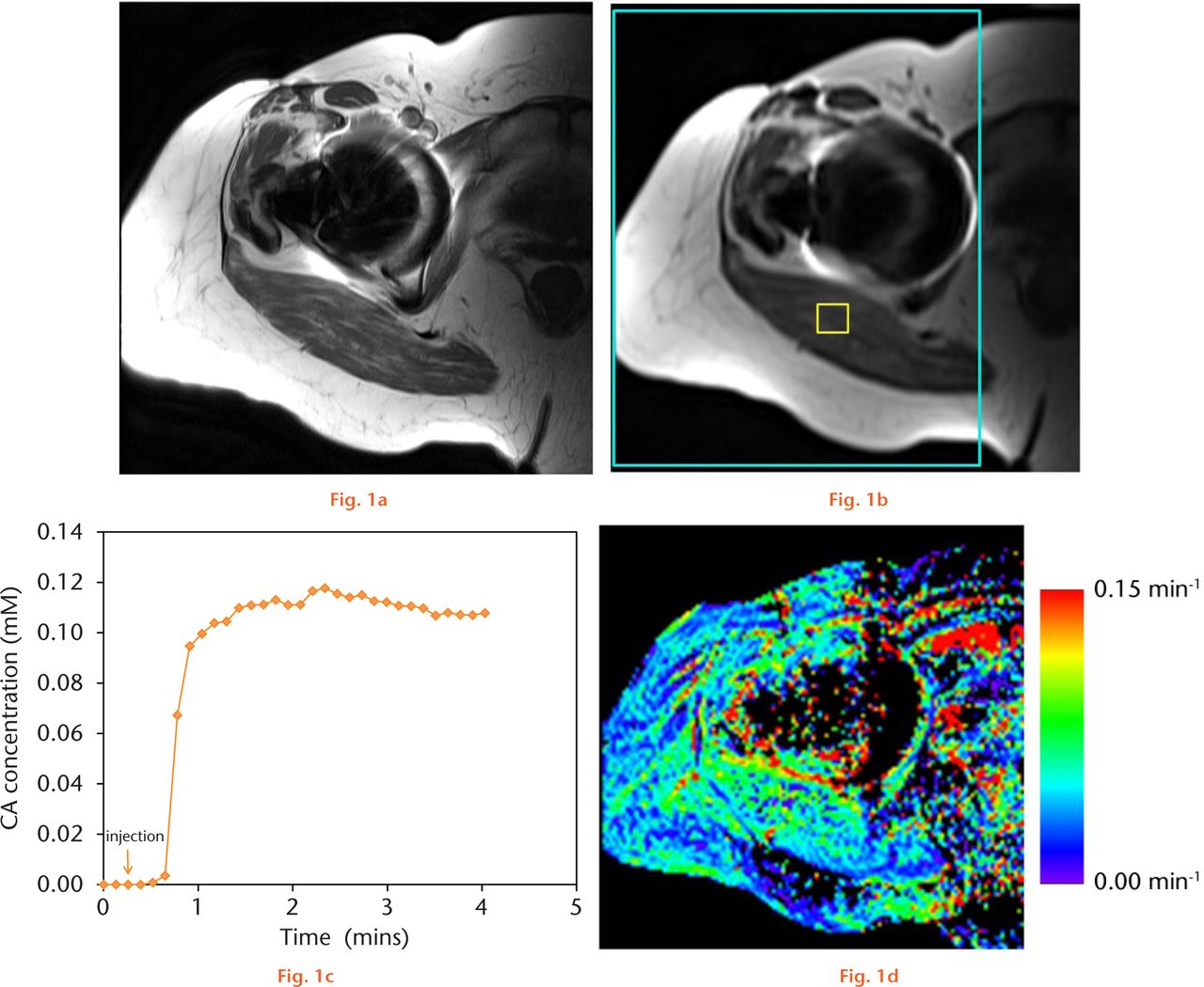  
          Example dynamic contrast enhanced (DCE)-MRI dataset for one patient. a) One slice of a high-resolution T1-weighted FSE sequence (standard-of-care anatomic imaging performed before DCE-MRI). b) Same slice location with one image of the DCE-MRI sequence. Small yellow box shows an region of interest (ROI) in muscle. Large cyan-coloured box shows the whole-tissue ROI used for mean Ktrans calculations. c) Example concentration-vs-time curve in the muscle ROI. d) Resultant Ktrans map, in units of min−1. The mean Ktrans value (counting non-zero values only), standard deviation, and standard error for this patient were 0.062, 0.049, and 0.00015, respectively.
        