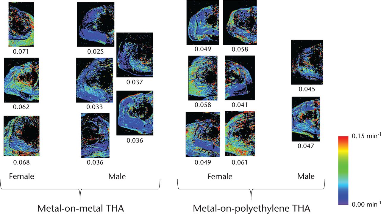 Fig. 2 
          All Ktrans maps (one slice shown per patient), grouped by THA implant type and gender. The maps have been cropped to show only the regions lateral to the bladder which were used for computations. Mean Ktrans value (in units of min−1) is displayed under each map. For each patient, the standard deviation across all Ktrans values was approximately 0.8 times the mean Ktrans value. The standard error was approximately 0.002 times the mean Ktrans value.
        