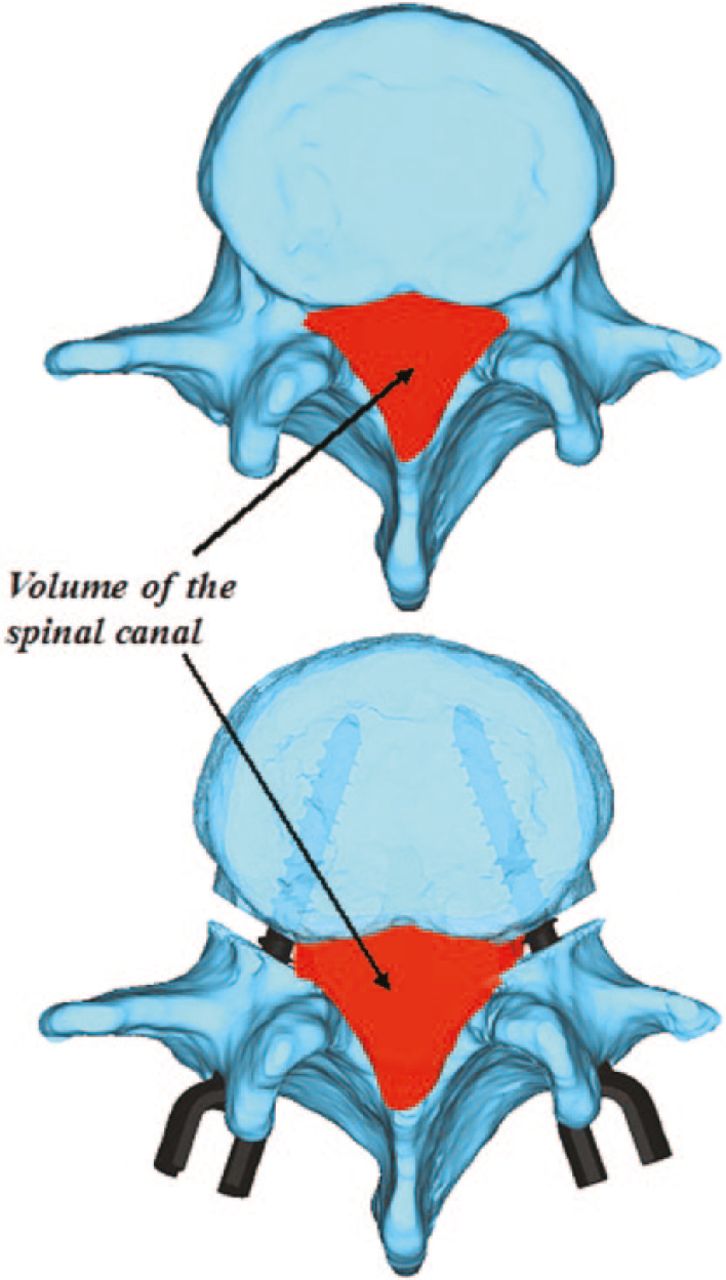 Fig. 1 
          L4 vertebrae before (upper) and after (lower) pedicle-lengthening osteotomy. The volume of the spinal canal is indicated.
        