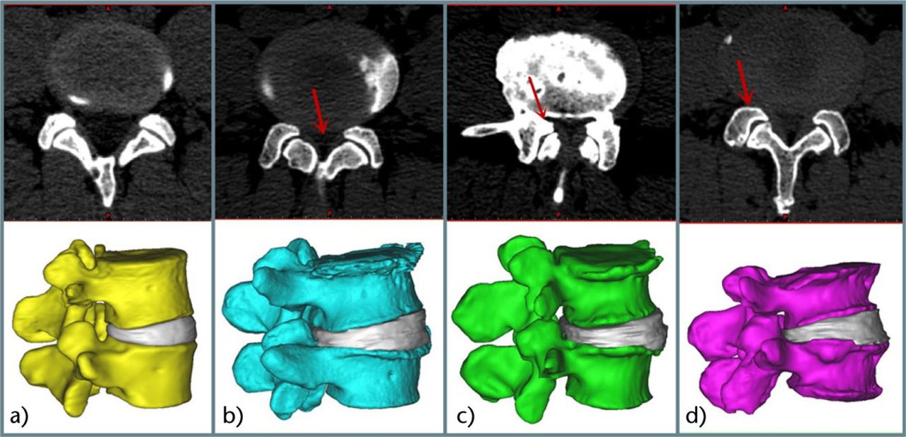 Fig. 2 
          Models of L4-L5 vertebrae and discs: a) control; b) central canal stenosis; c) lateral recess stenosis; d) foraminal stenosis.
        