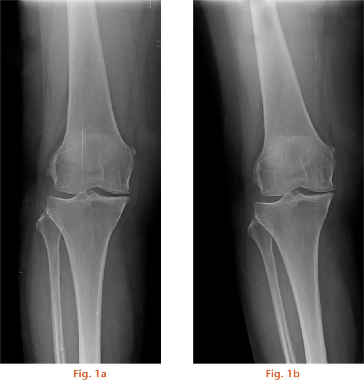  
          Radiographs showing the patient performing (a) both-legs and (b) one-leg standing anteroposterior view of the left knee.
        