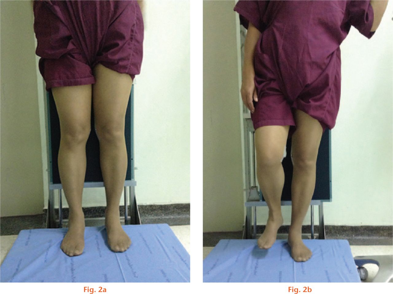  
          Photographs showing the method of performing (a) both-legs and (b) one-leg standing views of the knee.
        