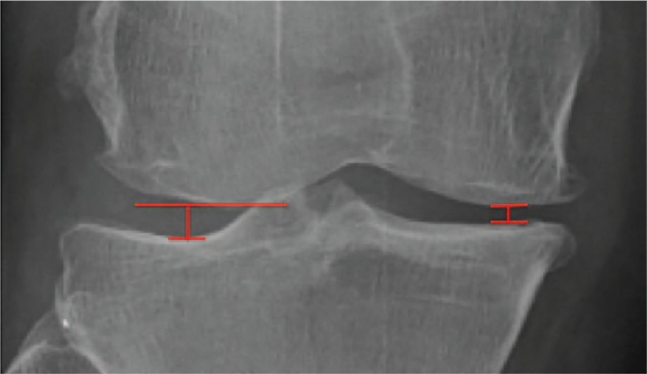 Fig. 3 
          Radiograph showing the measurement of joint space width of the medial and lateral joint spaces of the knee. We measured at the narrowest point of each joint space.
        