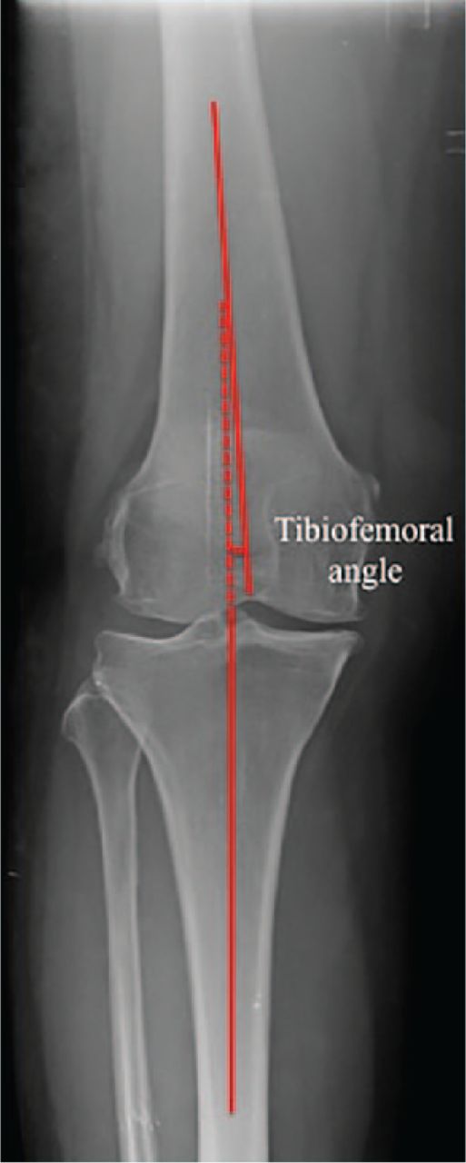 Fig. 4 
          Radiograph showing the measurement of the tibiofemoral angle.
        