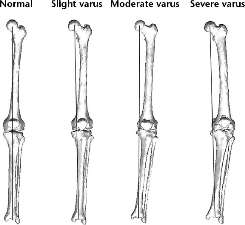 Fig. 1 
          Bone models constructed from CT data. The limb alignment was 0°, 6° varus, 10° varus, and 15° varus for the normal, slight varus, moderate varus, and severe varus models, respectively.
        