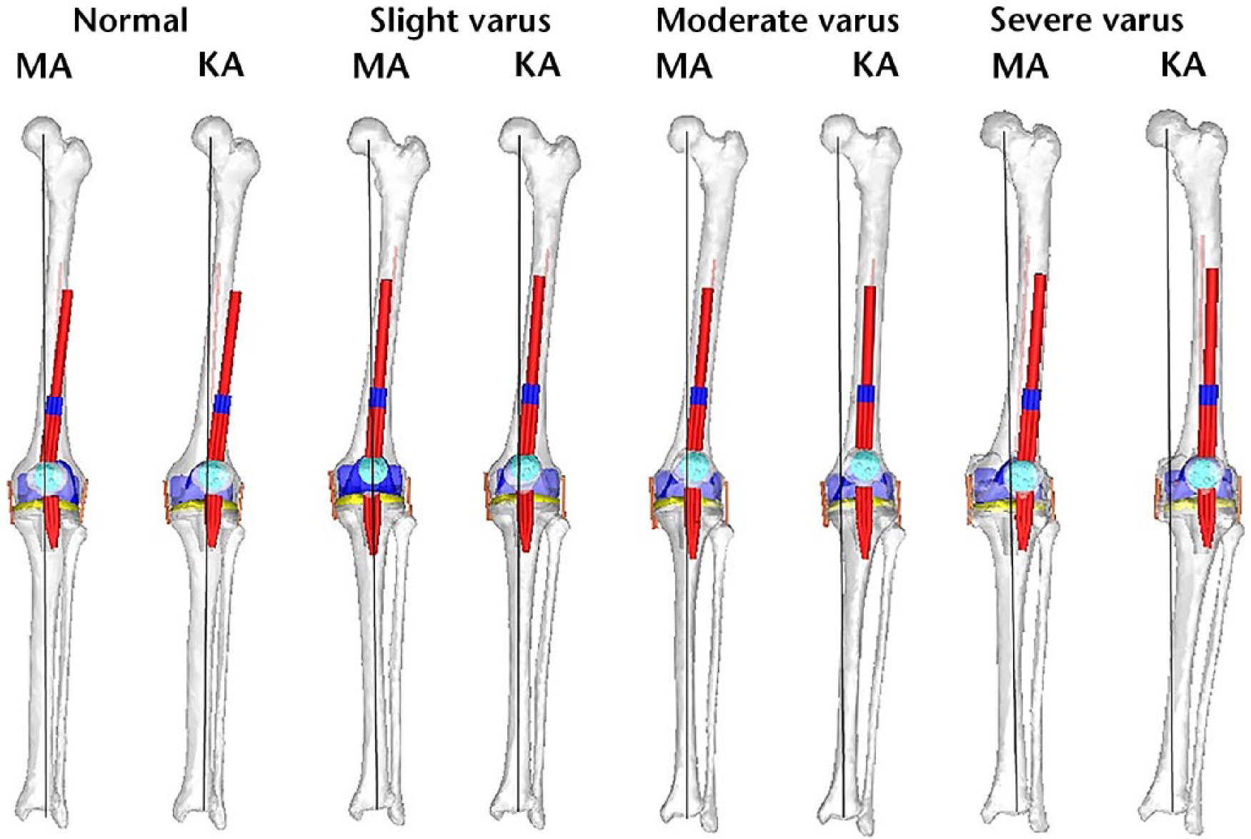 Fig. 2 
          Bone models after implantation with the mechanically aligned (MA) and kinematically aligned (KA) techniques.
        