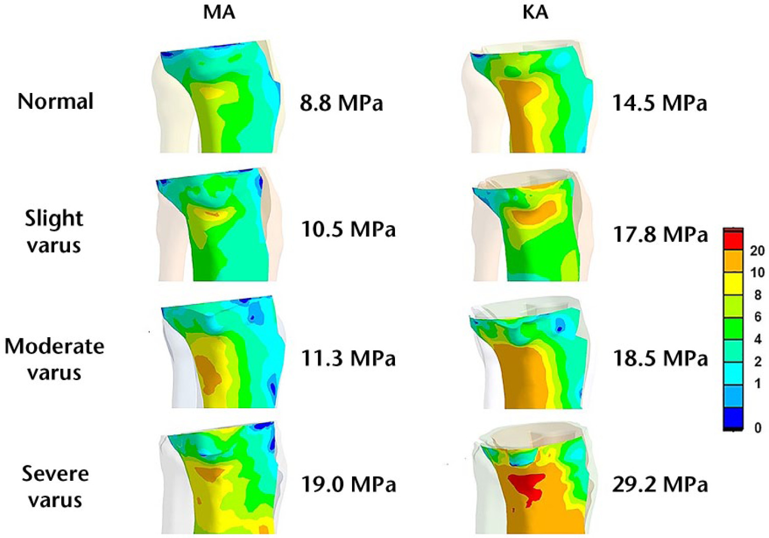 Fig. 7 
          Stress to the medial tibial cortex with the mechanically aligned (MA) and kinematically aligned (KA) techniques.
        