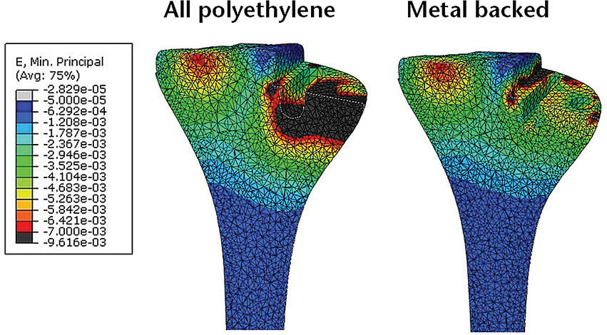 Fig. 6 
            Mid-coronal oblique contours of the cancellous bone for each 8 mm implant at total load of 4170 N (medial load 2500 N). Strain > -50 µε appears pale grey, strain < -7000 µε appears black.
          