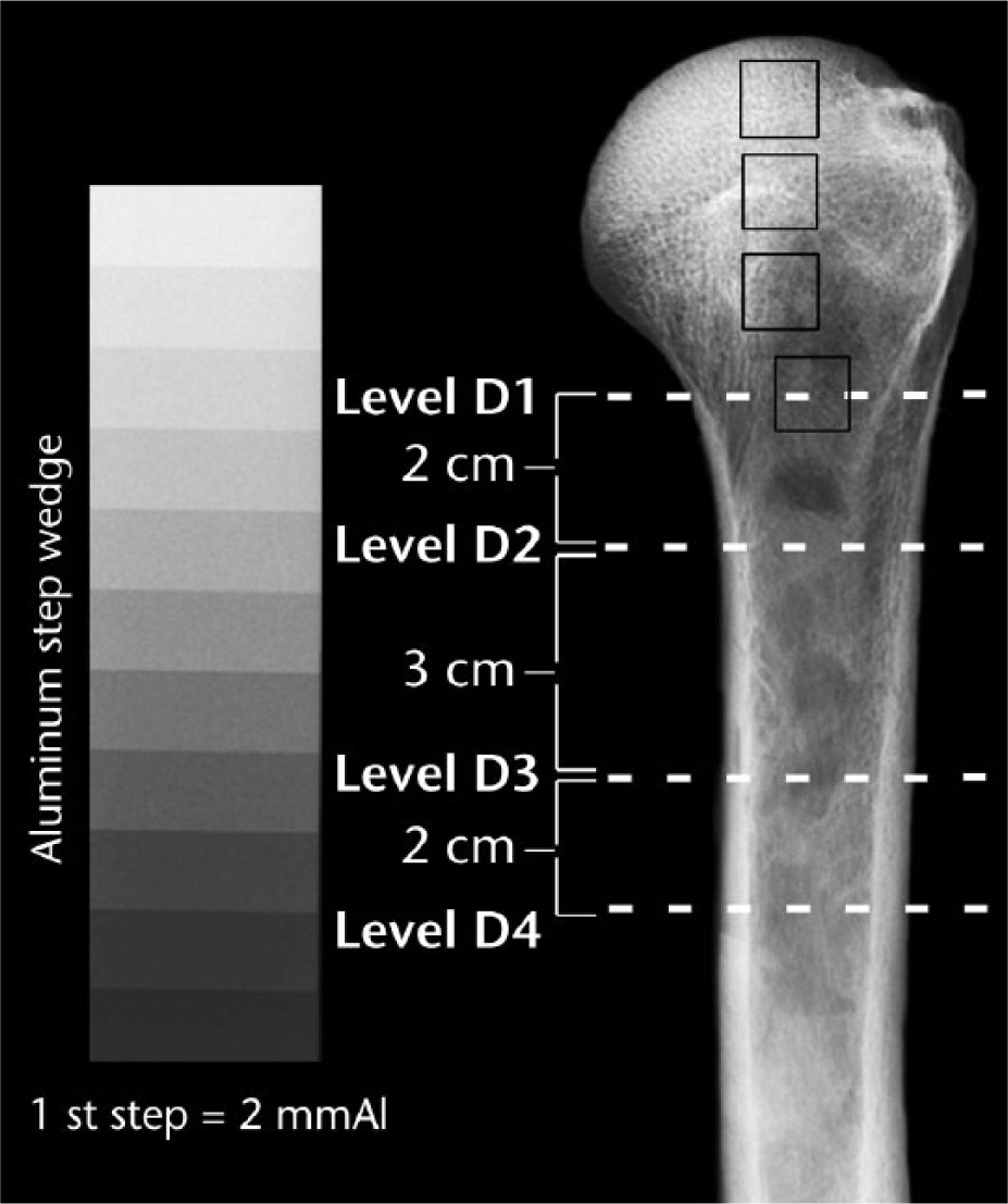 Fig. 1 
          Anteroposterior view of a left cadaver humerus showing the four measurement locations (dashed white lines) of the metaphysis/diaphysis, where D1 is the surgical neck. From top to bottom, the dark squares indicate head (H)1, H2, H3 and D1 locations where mmAl measurements were made.
        
