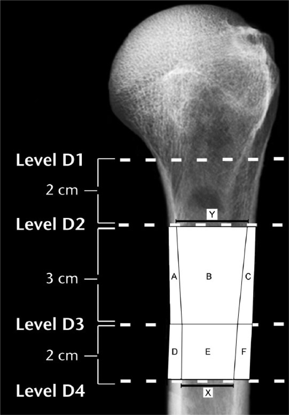 Fig. 2 
            In terms of the areas A-F that are shown diagrammatically in this radiograph, areal cortical index for the D2-D3 region is: [((A + B + C) – B) / (A + B + C)]. Areal cortical index for the D3-D4 region is: [((D + E + F) – E) / (D + E + F)]. The canal-to-calcar ratio is calculated as X/Y; as shown, these values were obtained from the D2 and D4 locations. The medial cortical ratio and an example of a linear cortical index measurement are shown in Figure 3. (D2, 2 cm below surgical neck; D3, 5 cm below surgical neck; D4, 7 cm below surgical neck.)
          