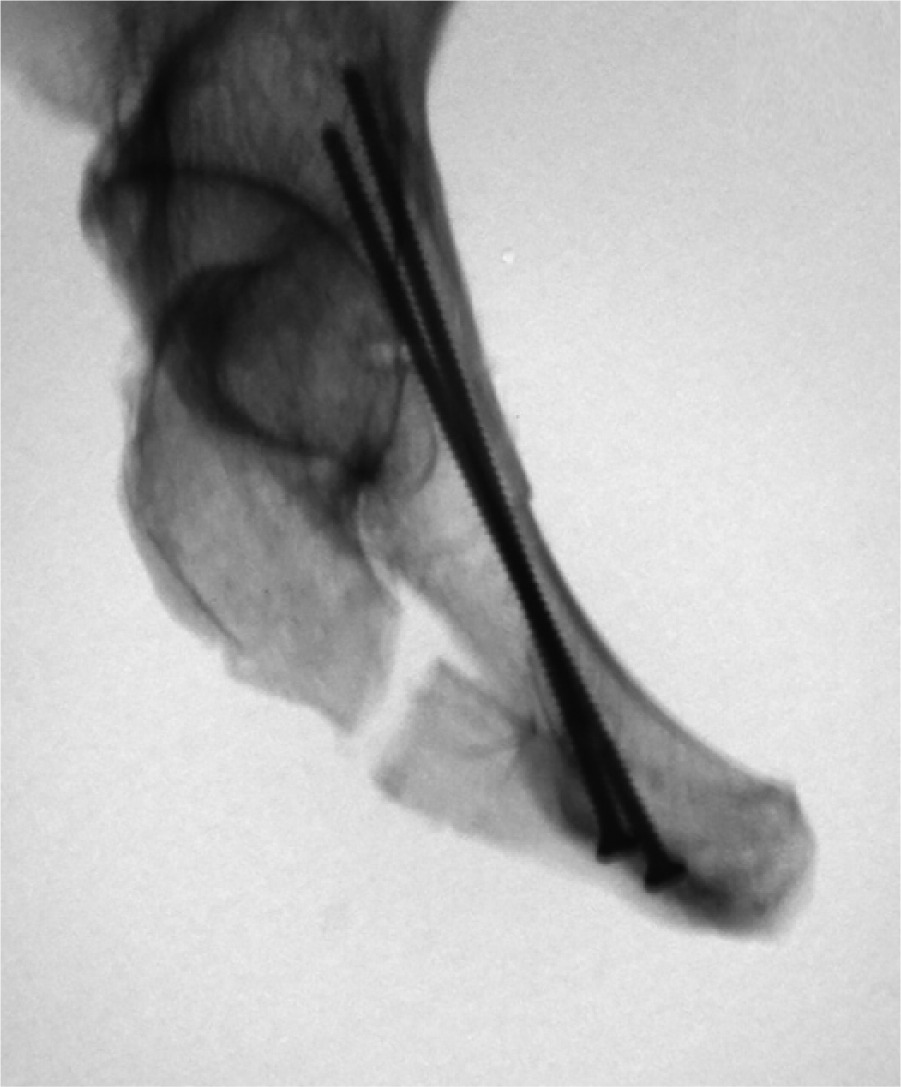 Fig. 1 
            Anterior pelvic ring fixation with two small-fragment screws (3.5 mm). The radiograph shows deflection of the screw at the acetabular cortex.
          