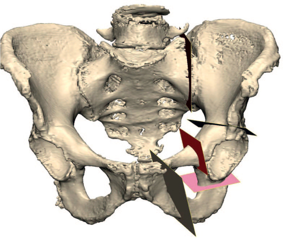 Fig. 1 
          Design of the five osteotomies using Materialise 3-matic. From left to right, top to bottom: single-plane sacroiliac; biplanar supra-acetabular; single-plane ischial; and parallel iliopubic osteotomies.
        