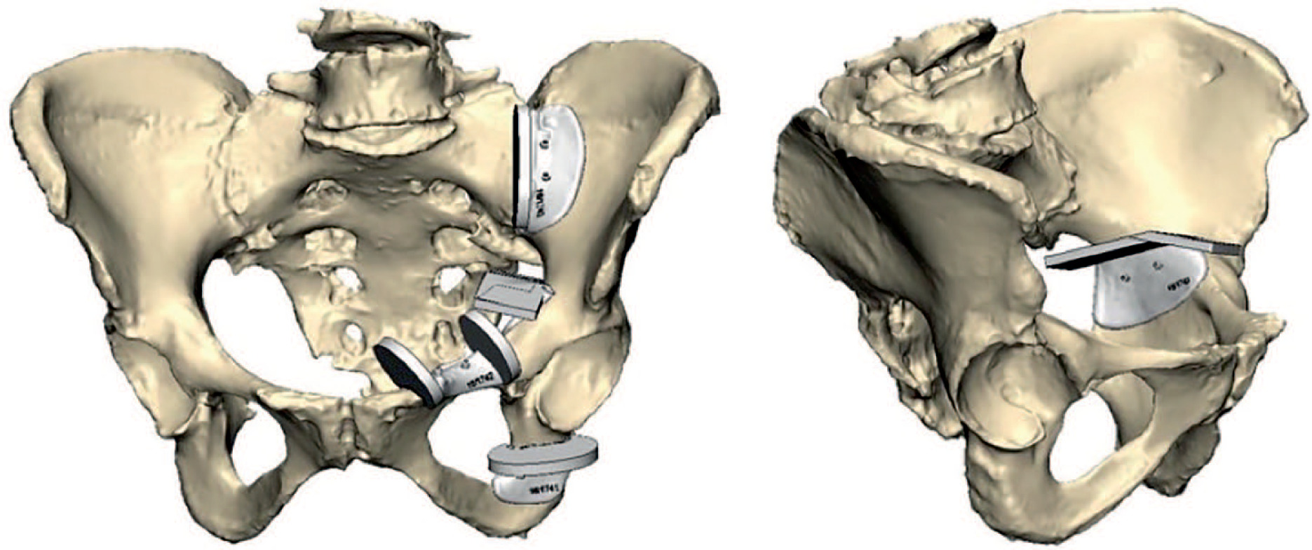 Fig. 2 
          Design of the patient-specific instruments using Materialise 3-matic software for each individual osteotomy.
        