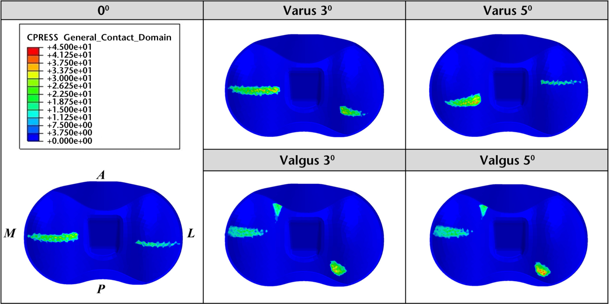 Fig. 4 
            Comparison of maximum contact stress distribution on the polyethylene insert with respect to varus and valgus malalignments.
          