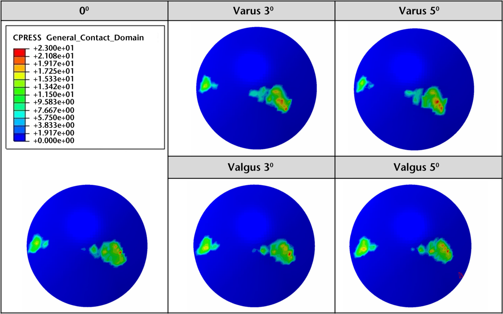 Fig. 6 
            Comparison of maximum contact stress distribution on patellar button with respect to varus and valgus malalignment.
          