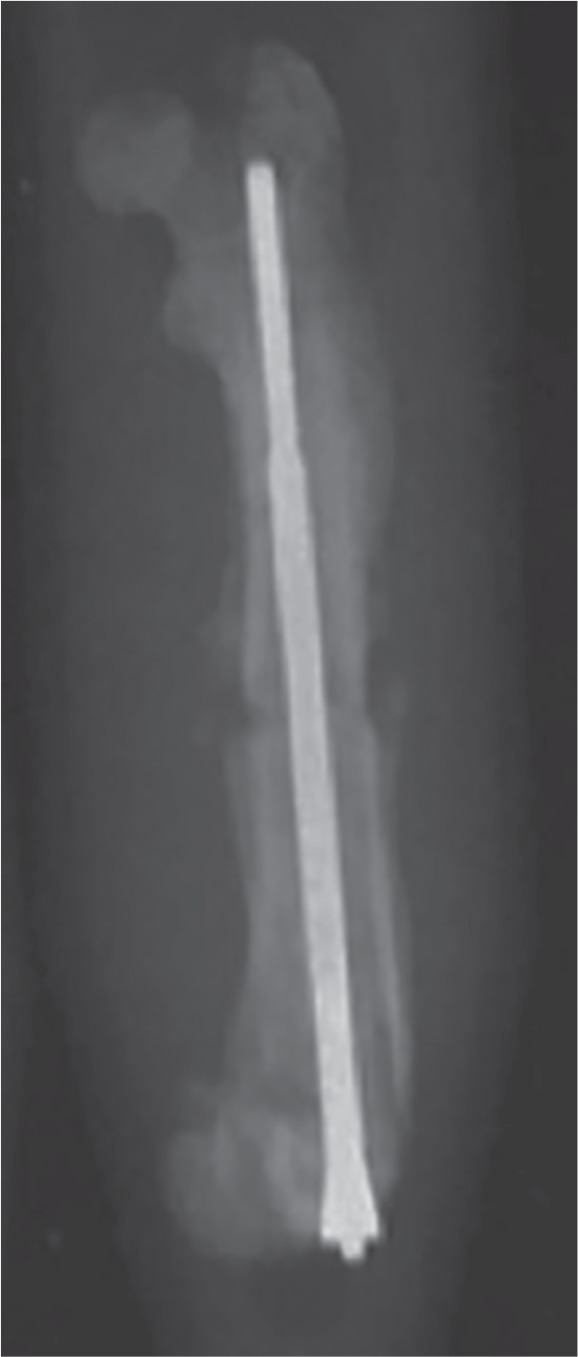 Fig. 1 
            Representative radiograph of a femur fixed with the intramedullary (IM) nail. The proximal end of the IM nail has a thread that permits compression of the femur fragments. This radiograph was taken after harvest at day 14.
          