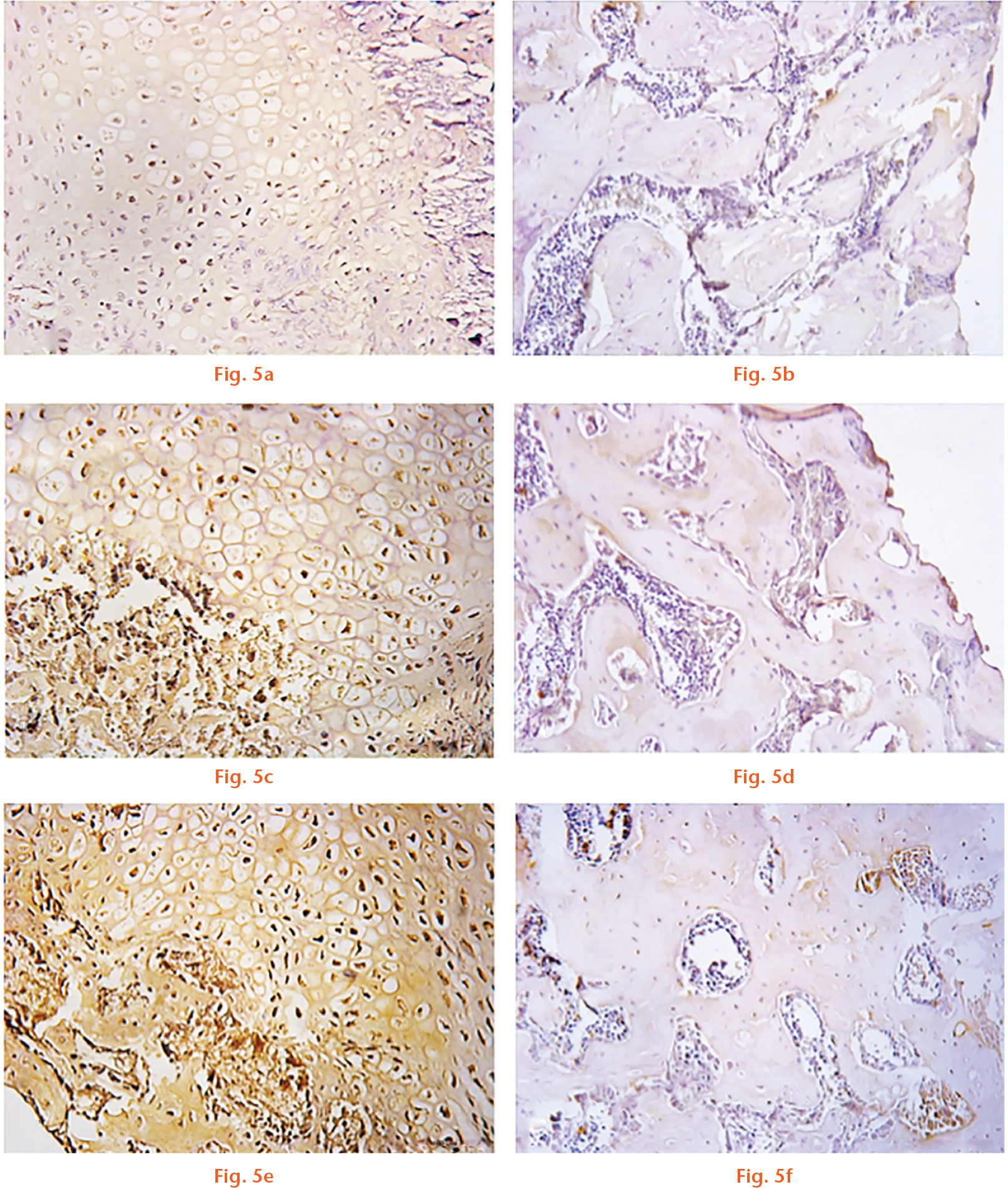  
            Effect of tadalafil and COMB-4 on inducible nitric oxide synthase (iNOS) expression at day 14 and day 42 after femoral osteotomy determined by immunohistochemistry. Microphotographs of iNOS expression taken at the osteotomy site: a) and b) are control; c) and d) are tadalafil; e) and f) are COMB-4. Panels (a), (c) and (e) depict 14-day results and panels (b), (d) and (f) depict 42-day results.
          